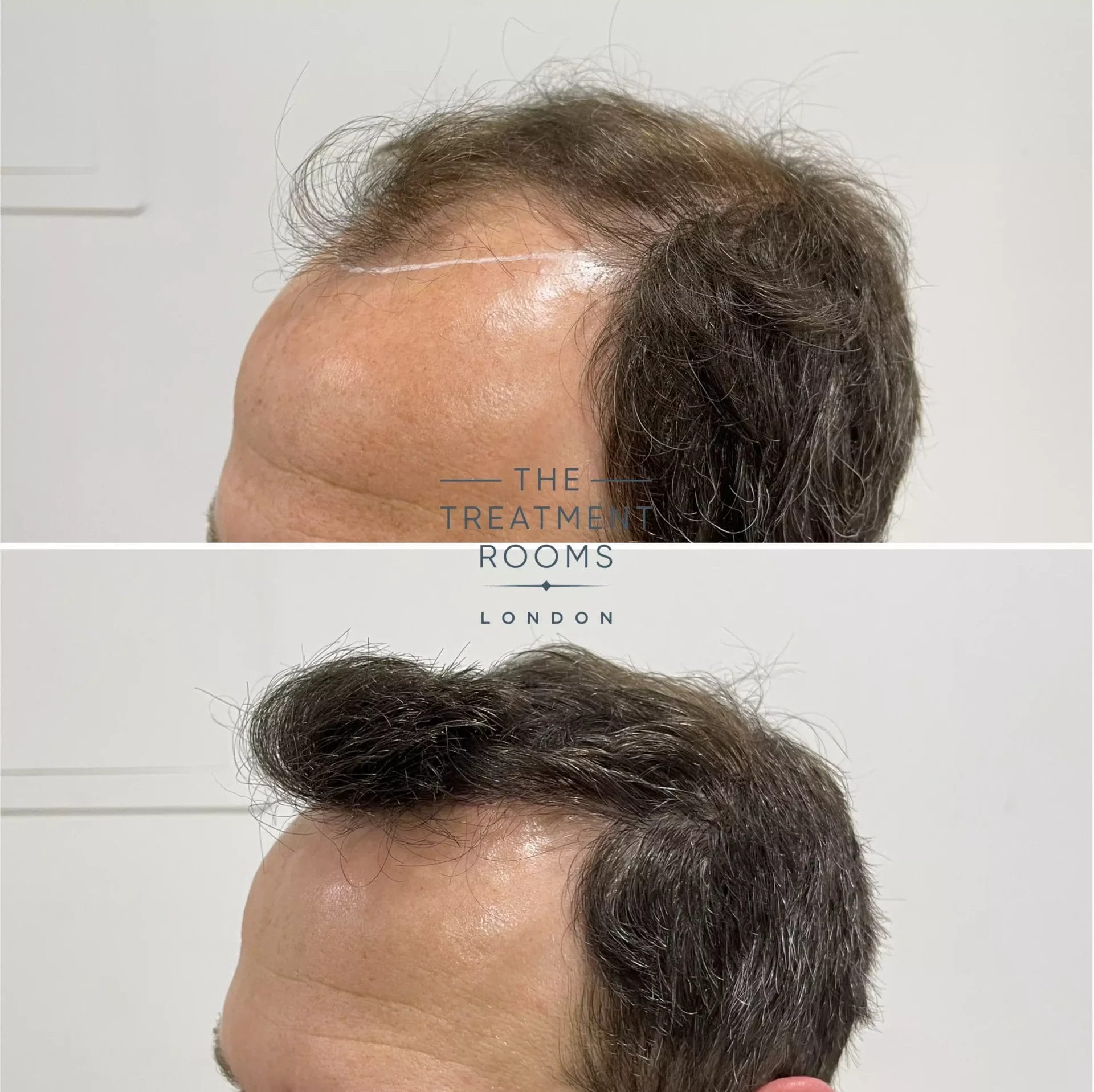 FUE Hair Transplant Result 2076 Grafts Treatment Rooms London