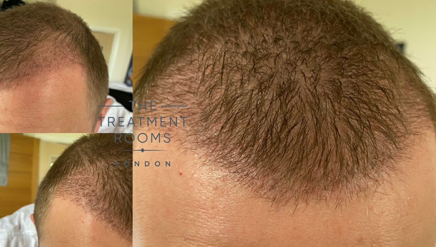 1 month after hair transplant