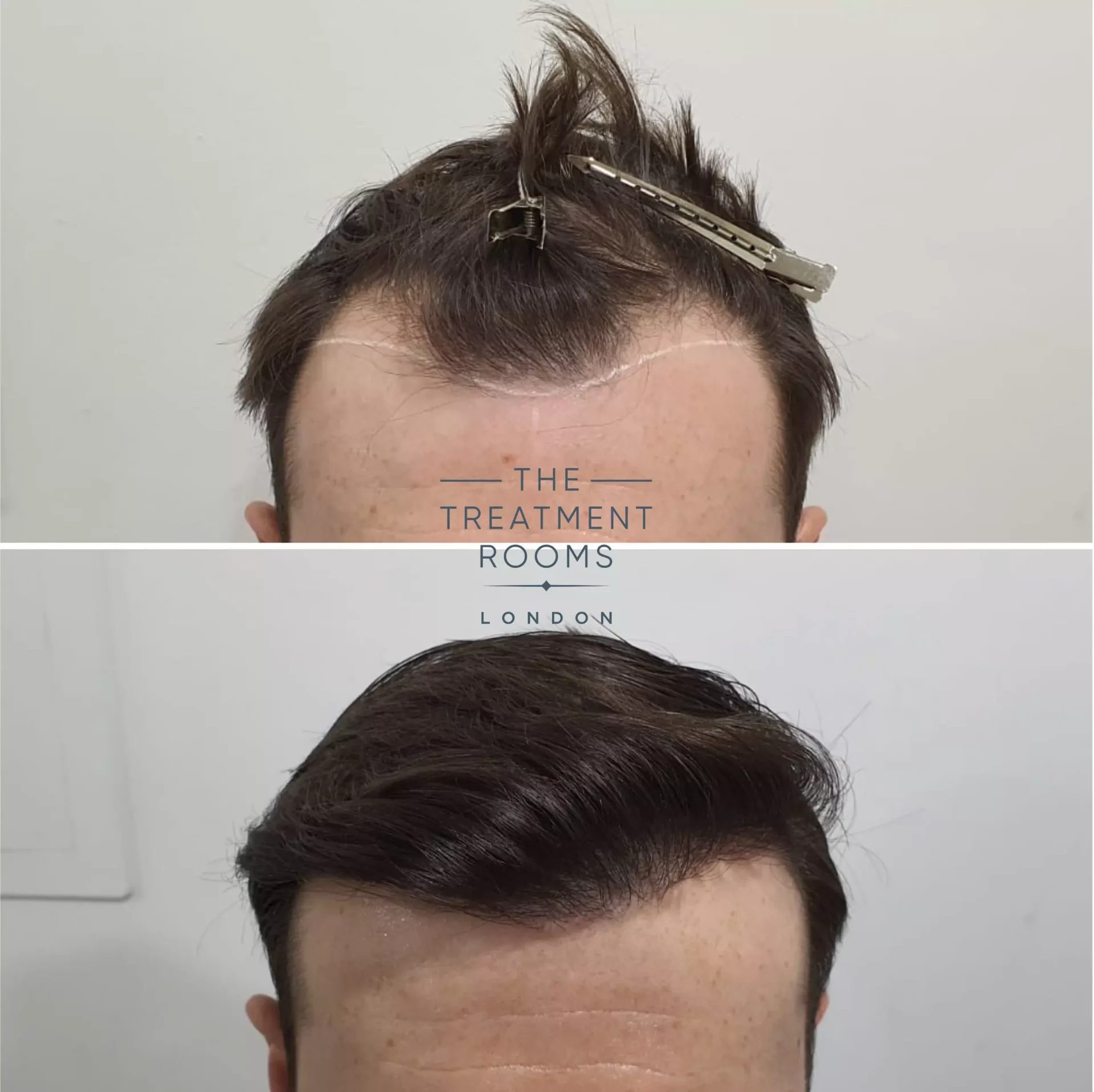 1014 grafts temple fue hair transplant before and after 1014 grafts temple fue hair transplant before and after