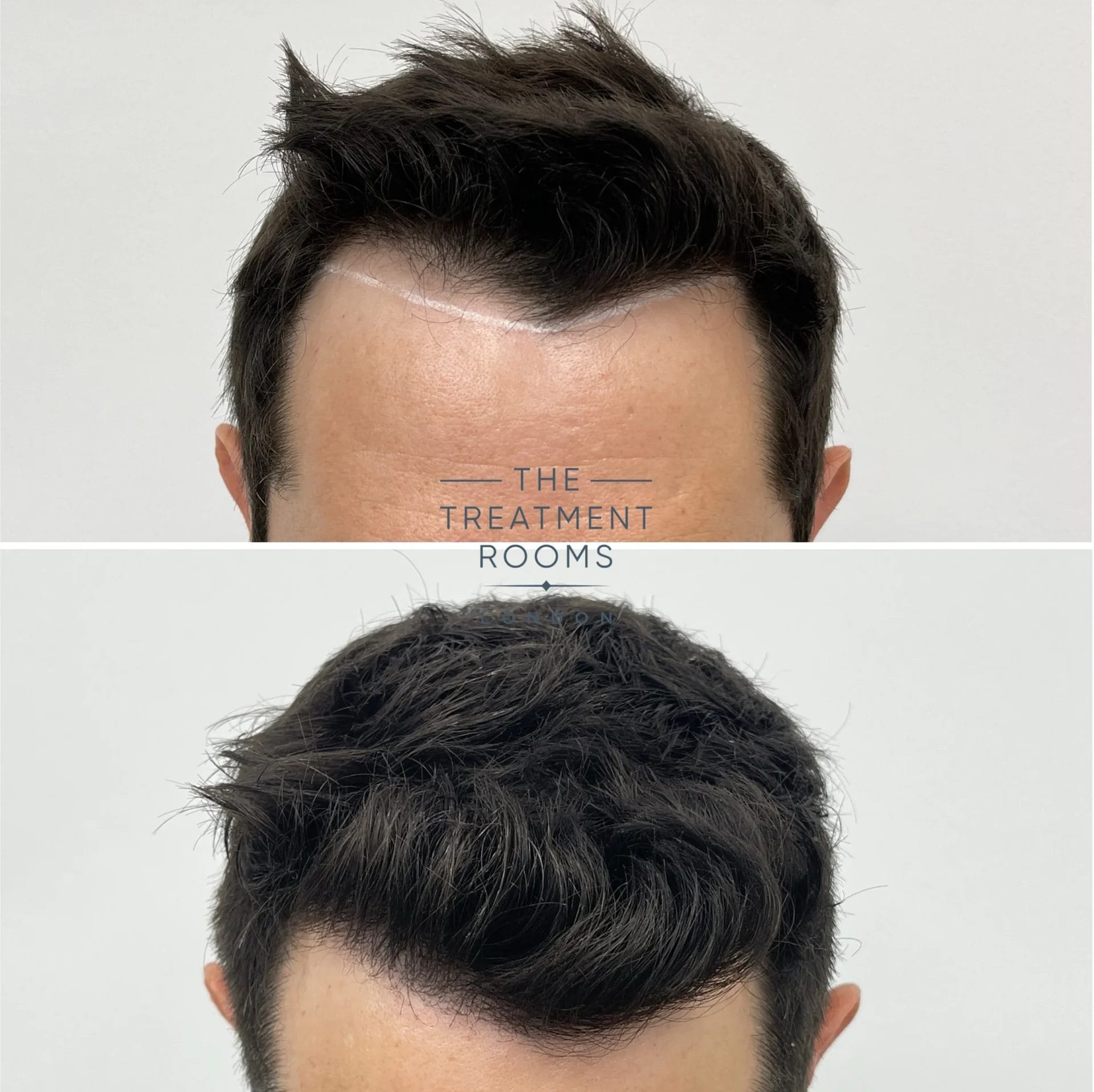 1039 grafts hairline transplant before and after