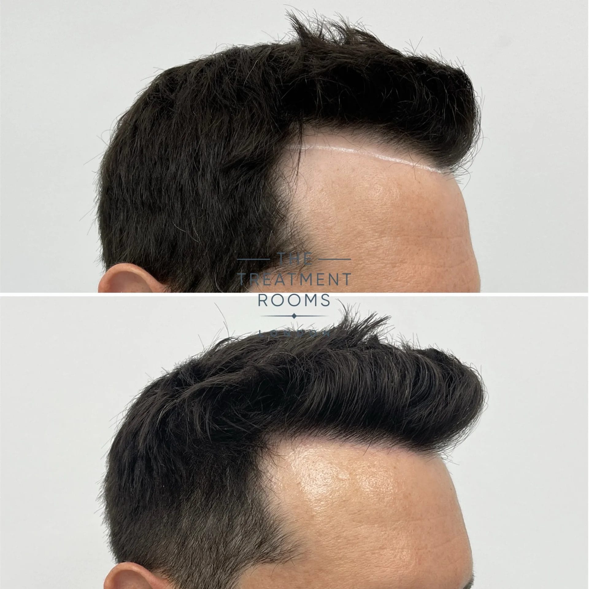 1039 grafts hairline transplant result