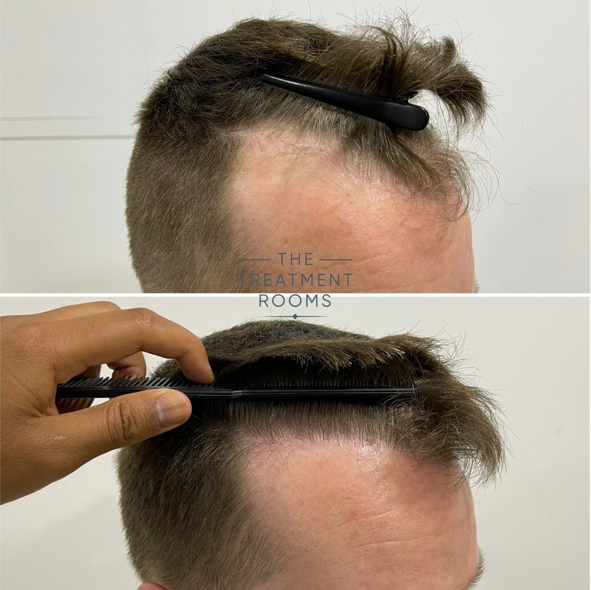 1073 grafts fue hair transplant before and after right temple