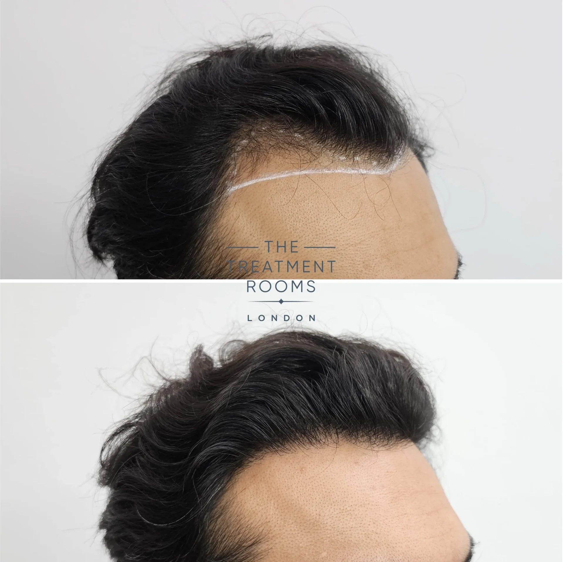 1204 grafts best hair transplant before and after