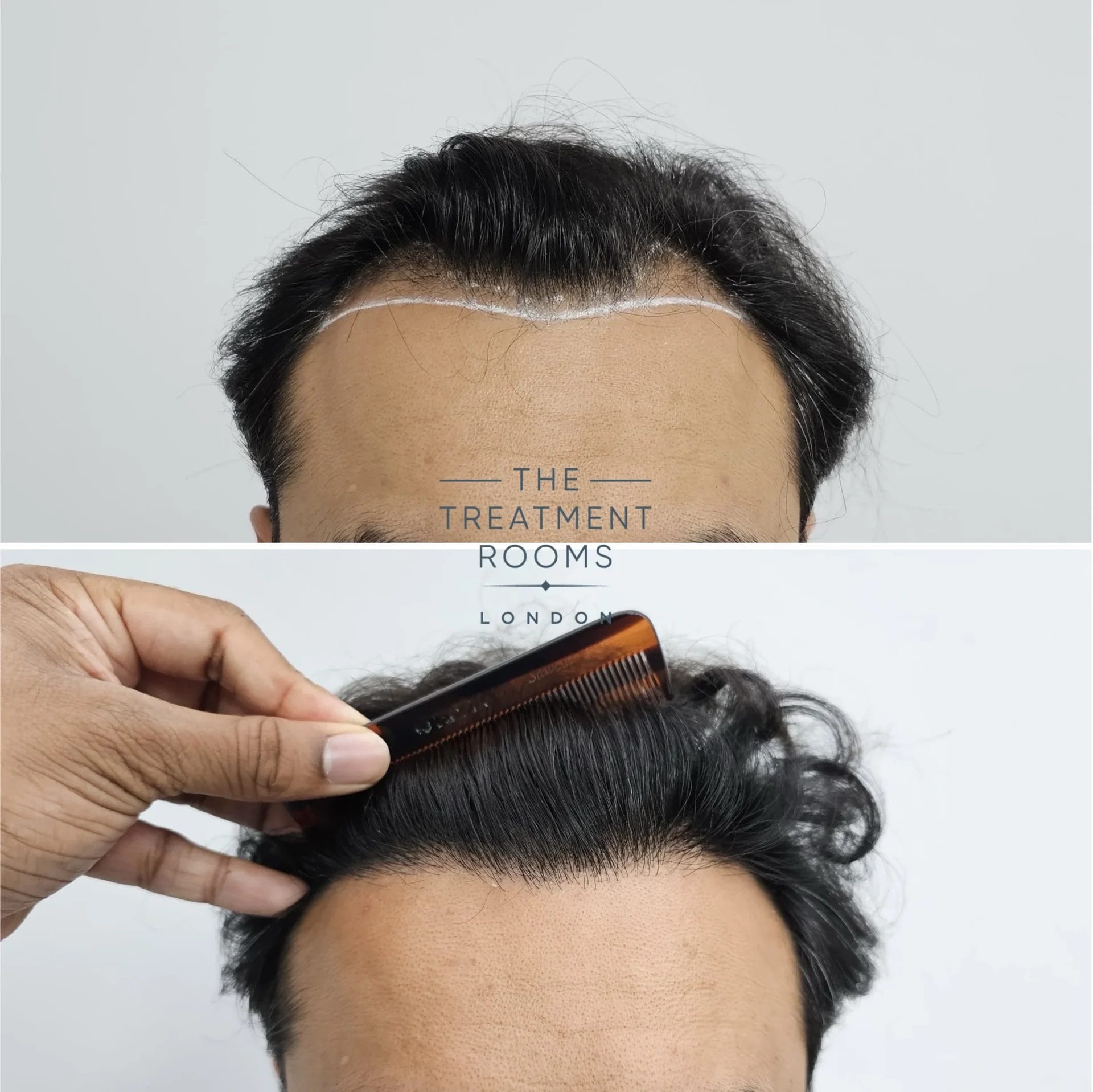 1204 grafts hair transplant before and after