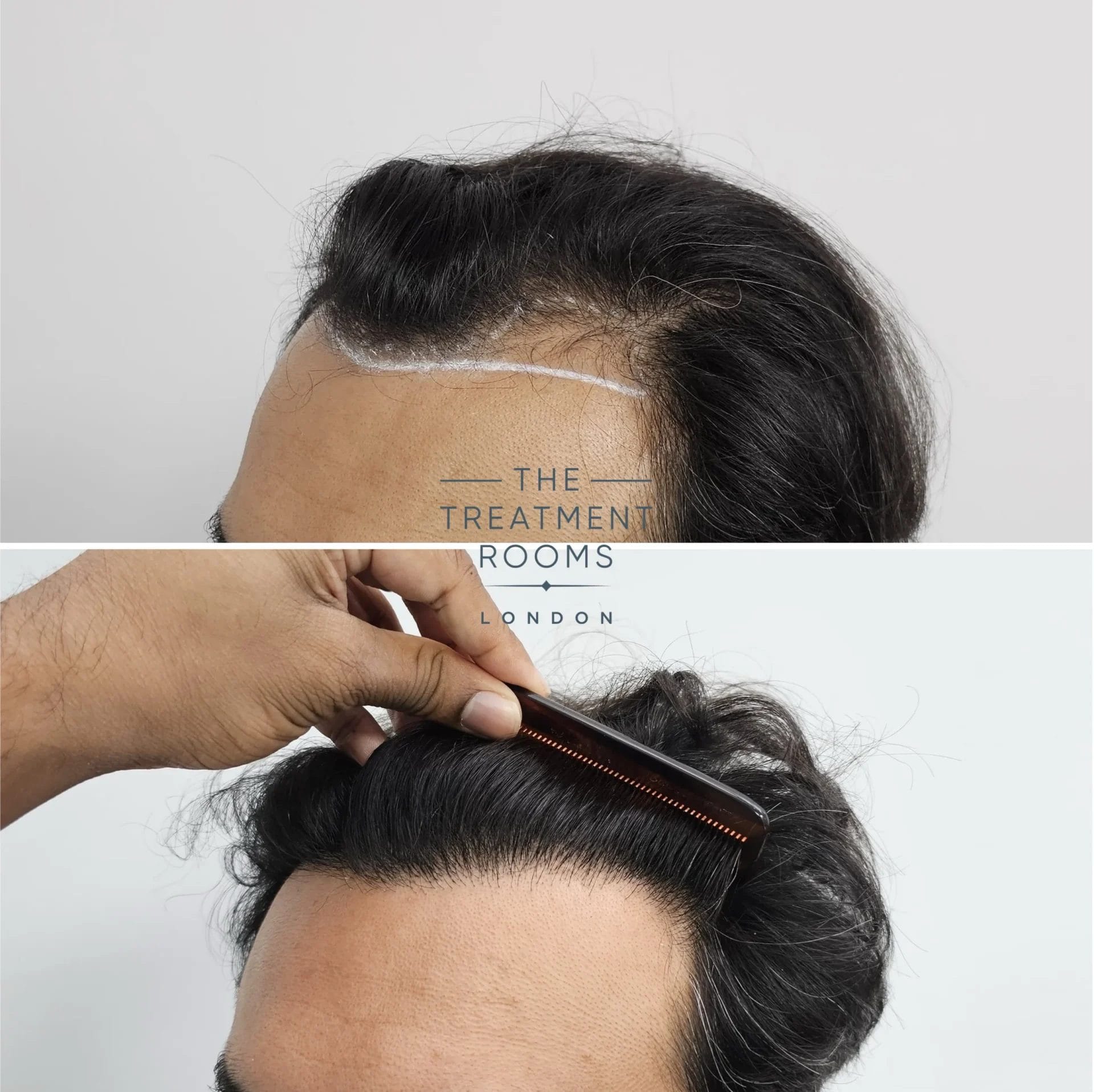 1204 grafts hairline fue transplant before and after