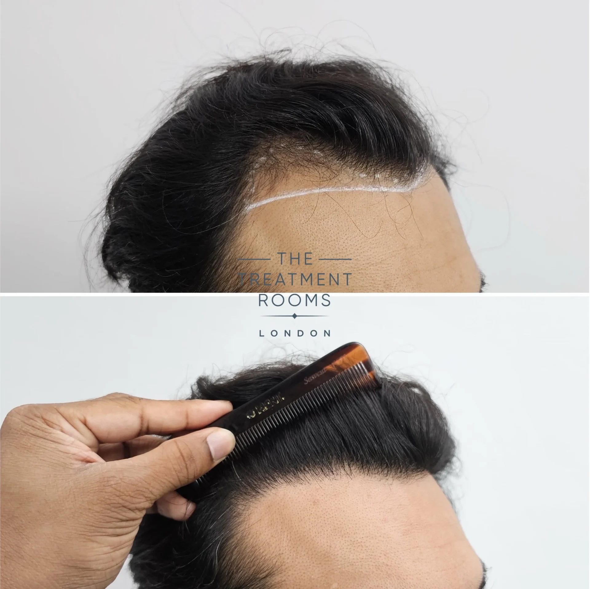 1204 grafts hairline transplant before and after