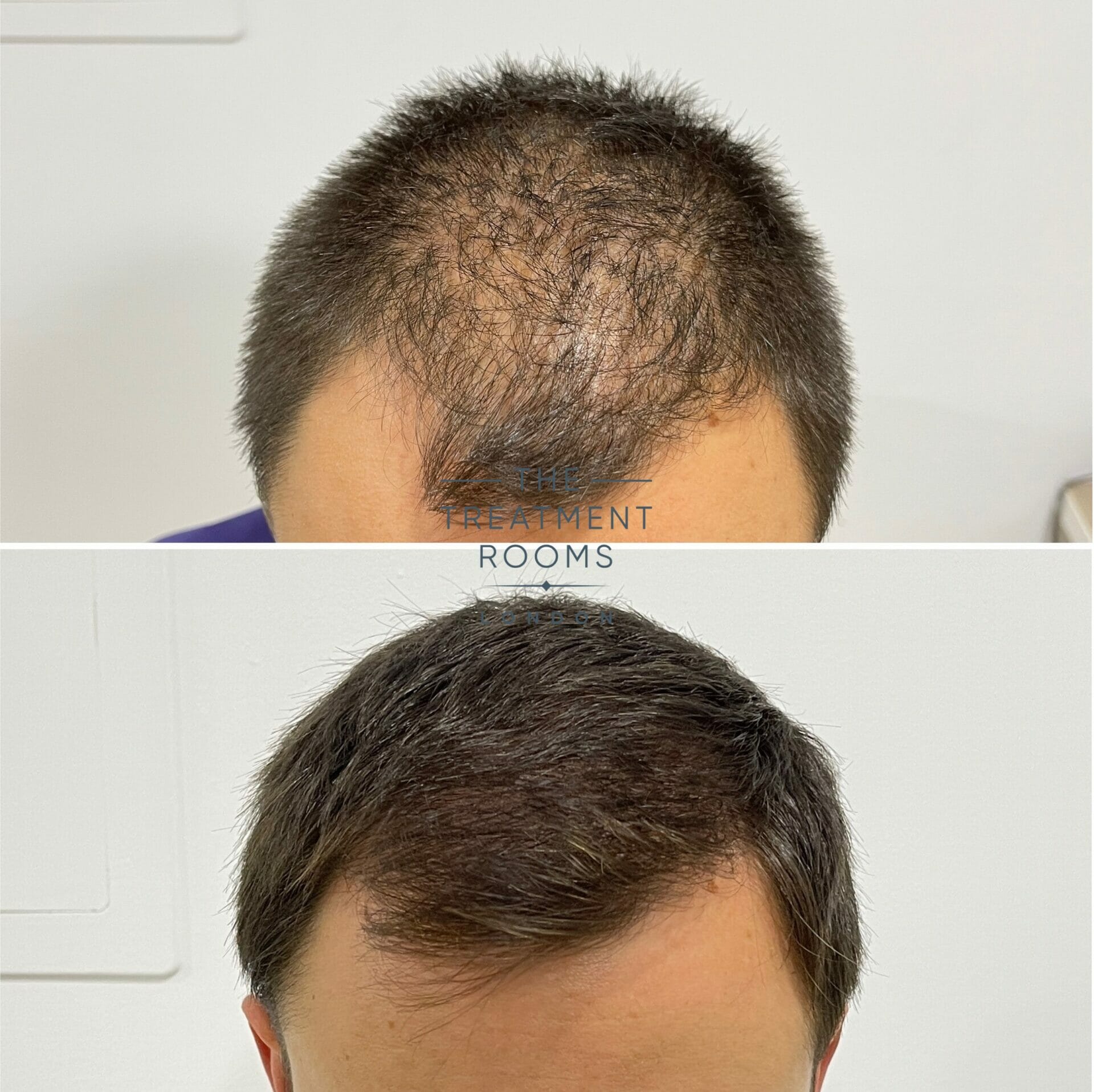 1240 grafts fue hair transplant london 1240 grafts fue hair transplant london