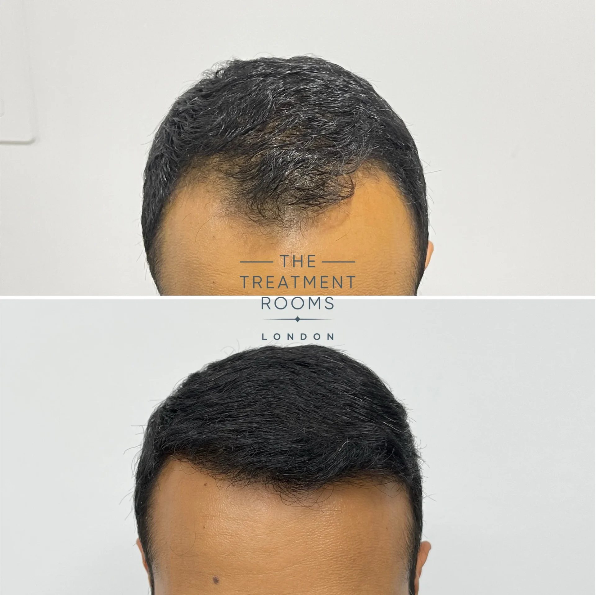 1314 grafts fue hair transplant before and after