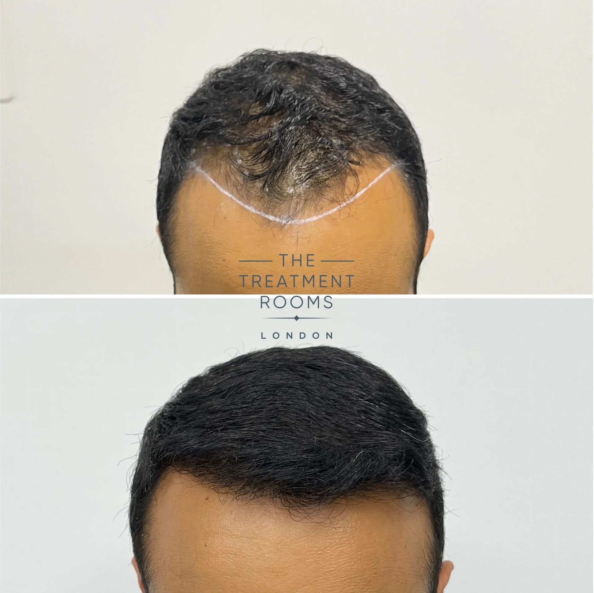 1314 grafts hairline transplant result