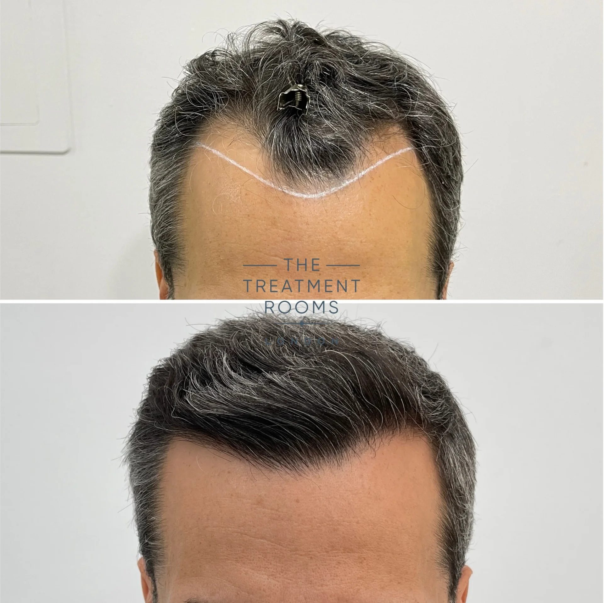 1318 grafts best hairline transplant clinic before and after