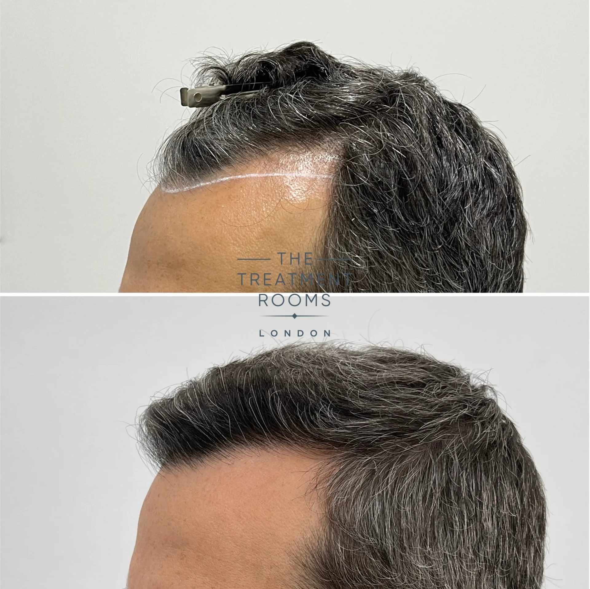 1318 grafts hairline fue transplant before and after