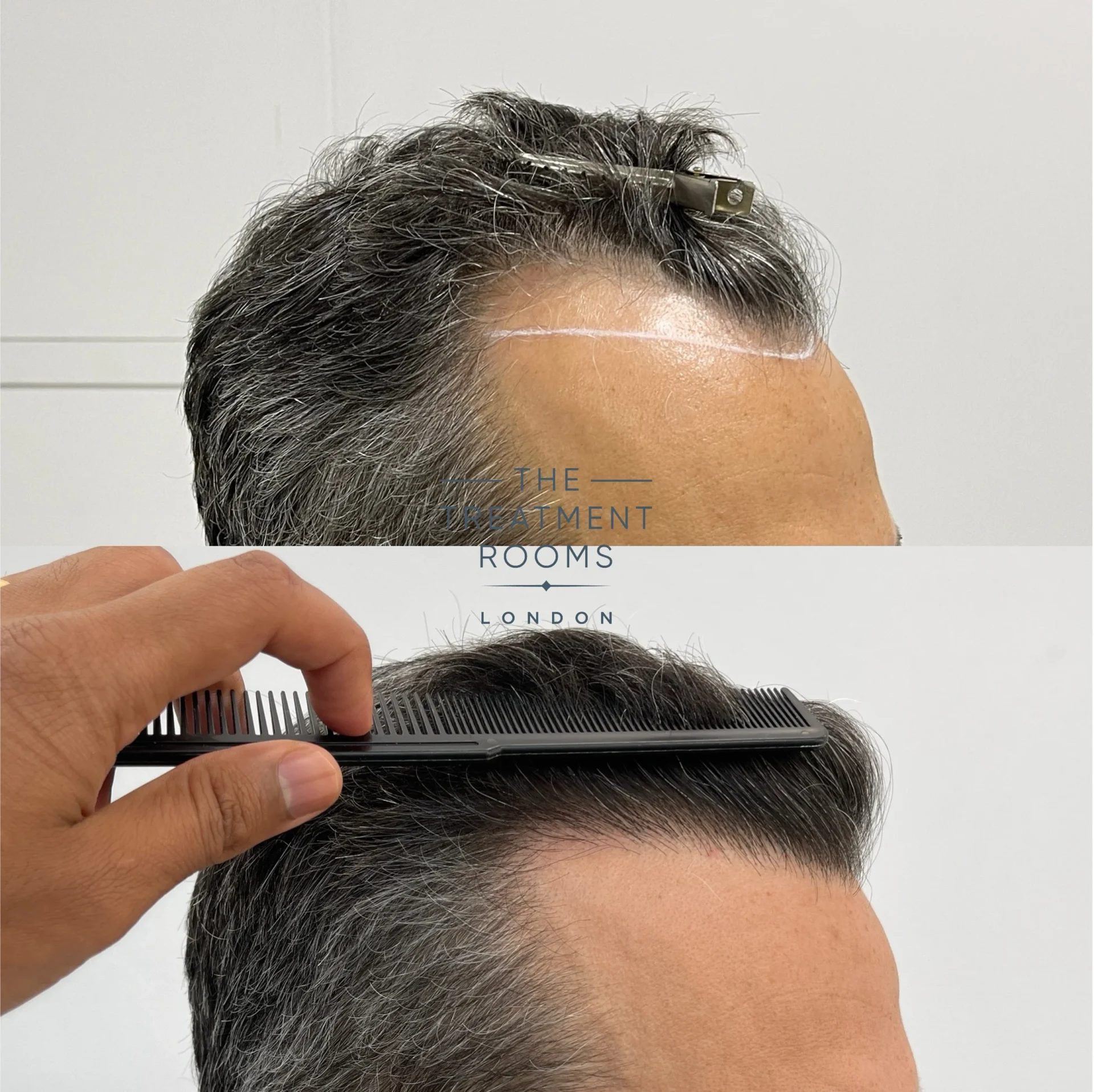 1318 grafts hairline transplant before and after