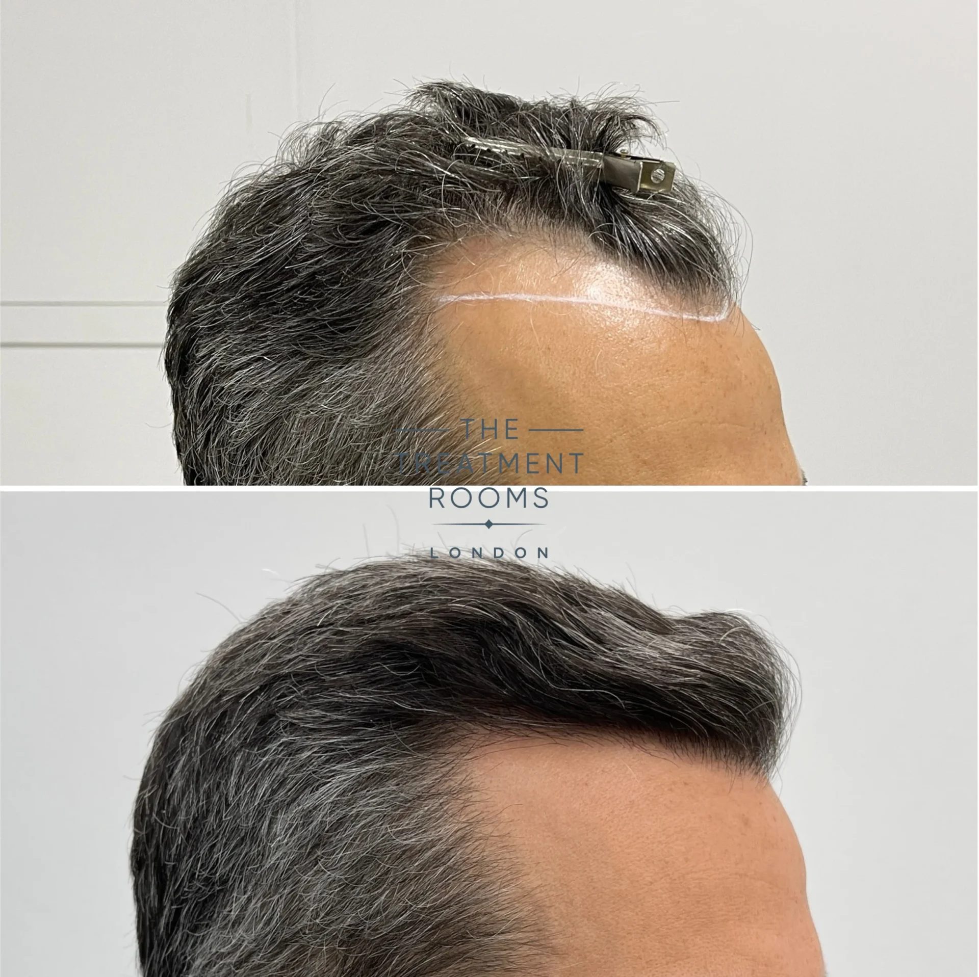 1318 grafts hairline transplant london before and after