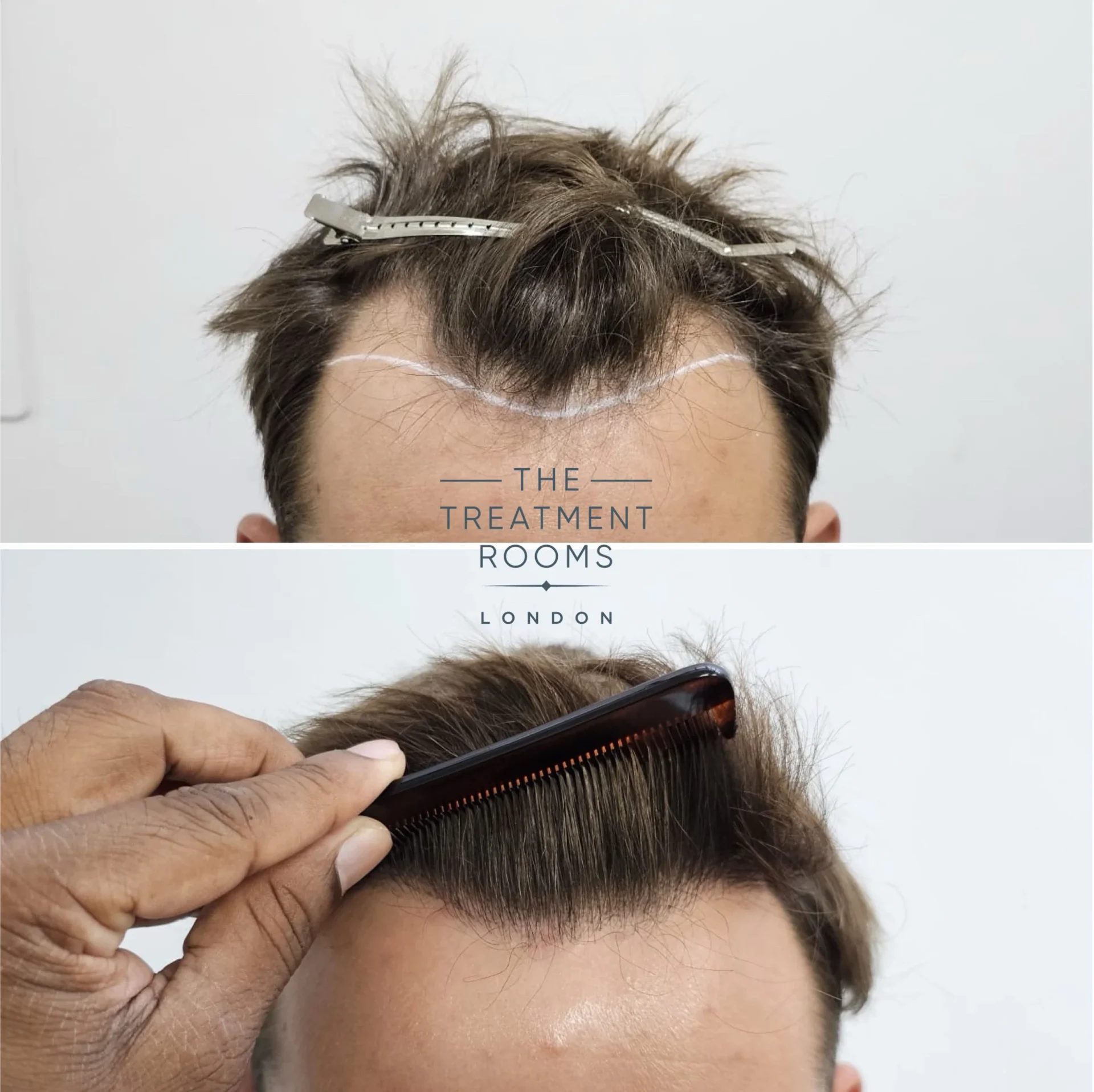 1332 grafts fue hairline transplant before and after