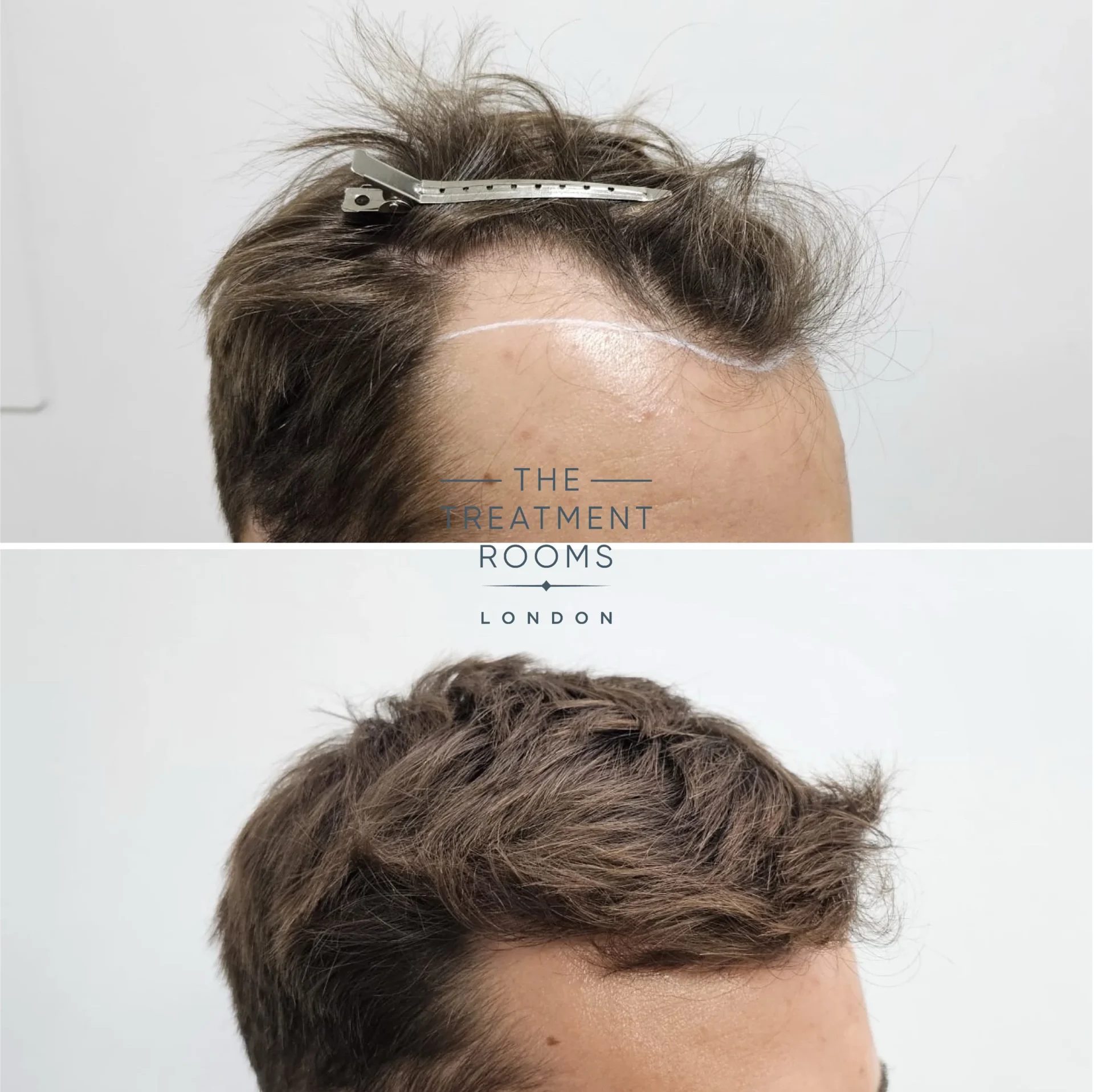 1332 grafts hairline transplant before and after