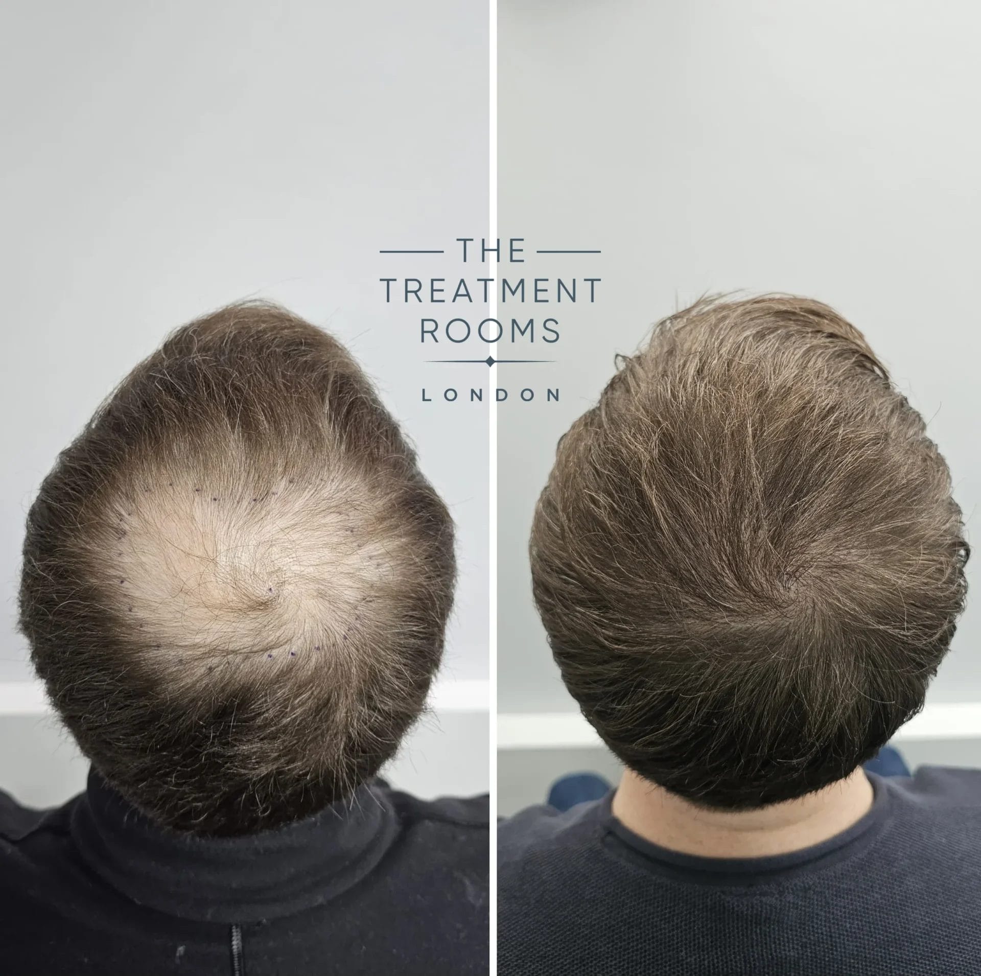 1380 Grafts FUE Crown Hair Transplant Before and After