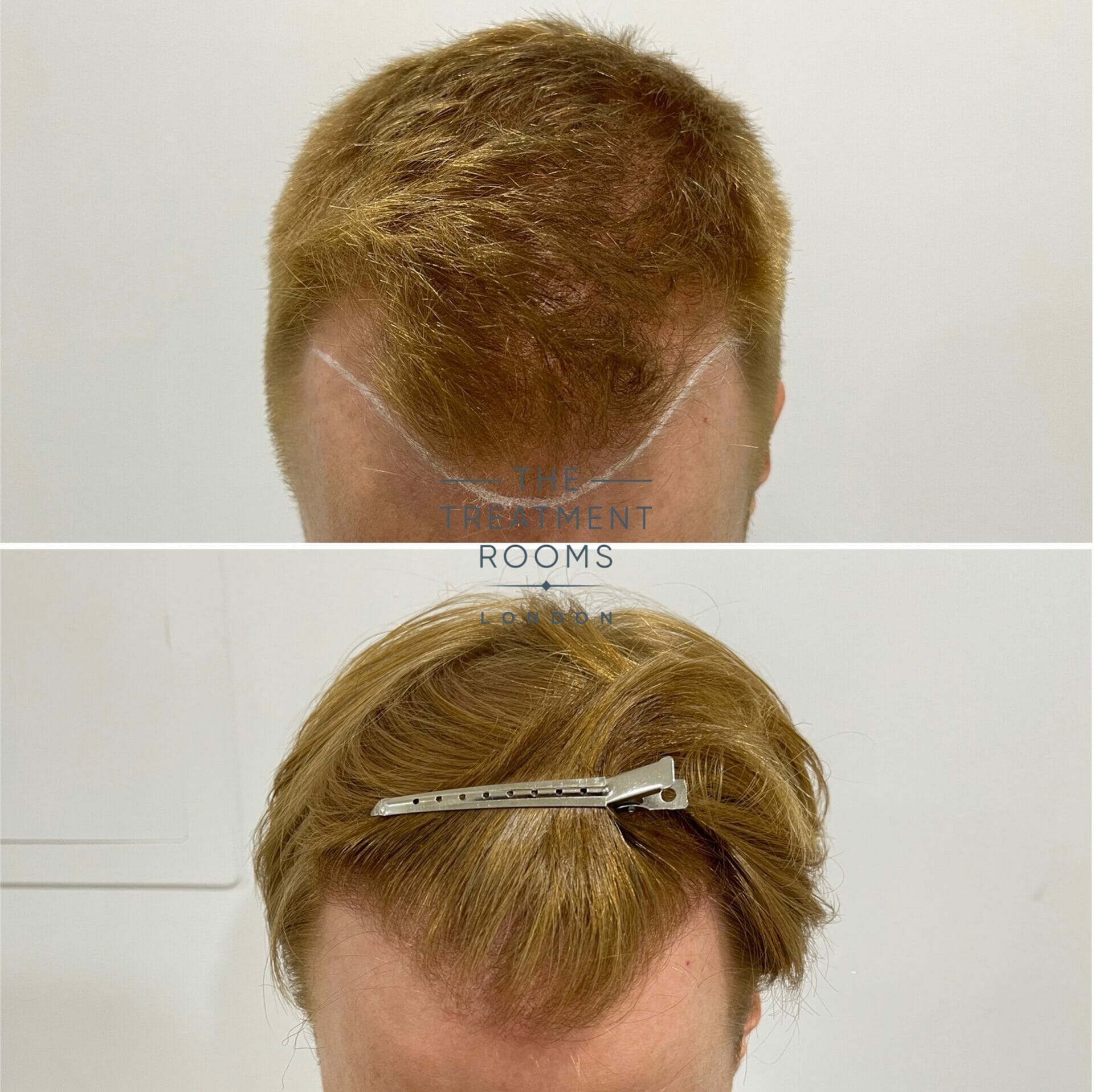 1426 grafts fue hair transplant receding hairline before and after 1426 grafts fue hair transplant receding hairline before and after