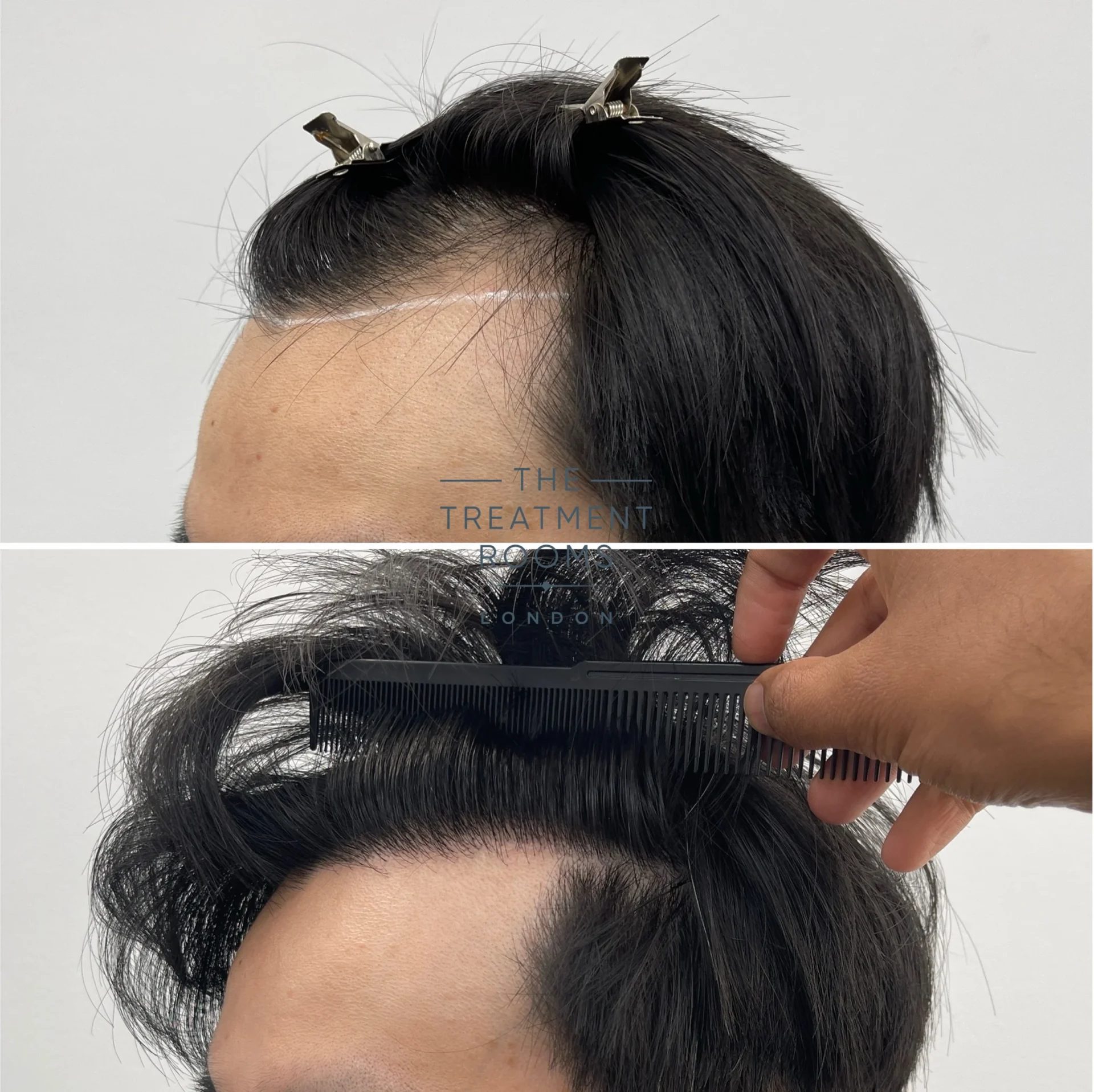 1431 grafts fue hairline transplant before and after
