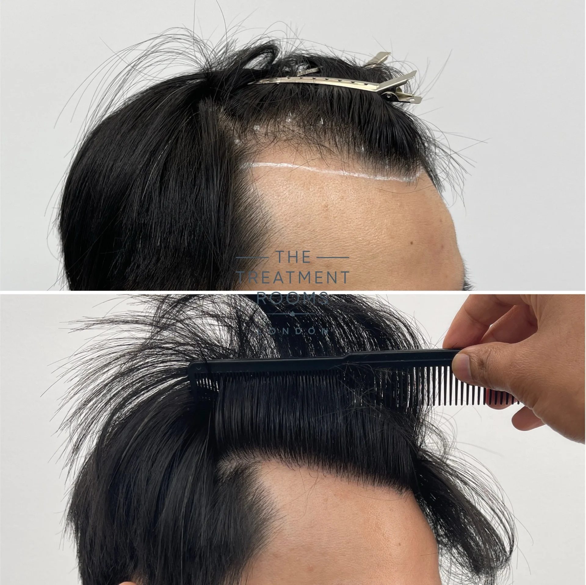 1431 grafts hairline transplant before and after