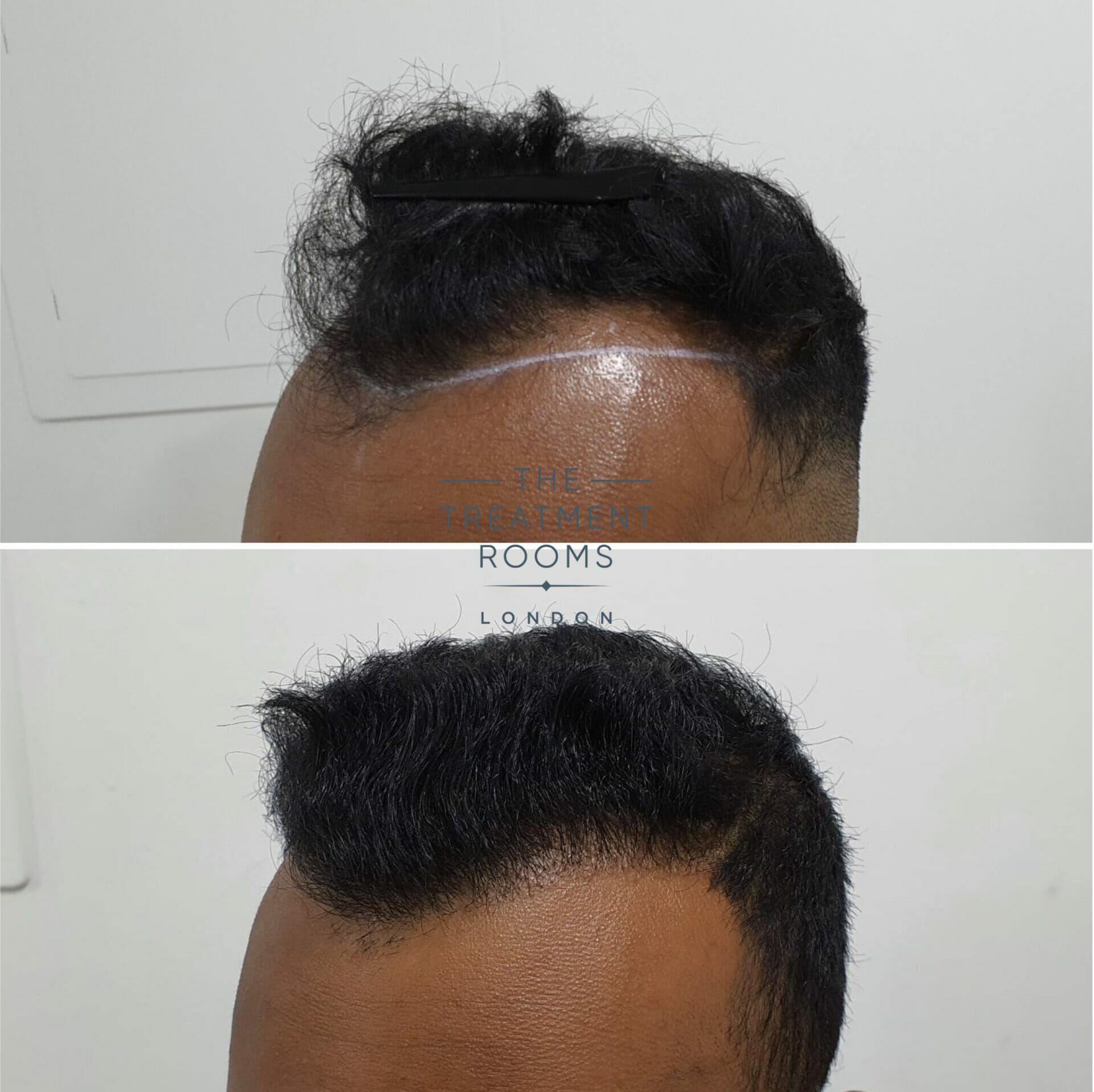 1546 grafts FUE hair transplant london before and after 1546 grafts FUE hair transplant london before and after