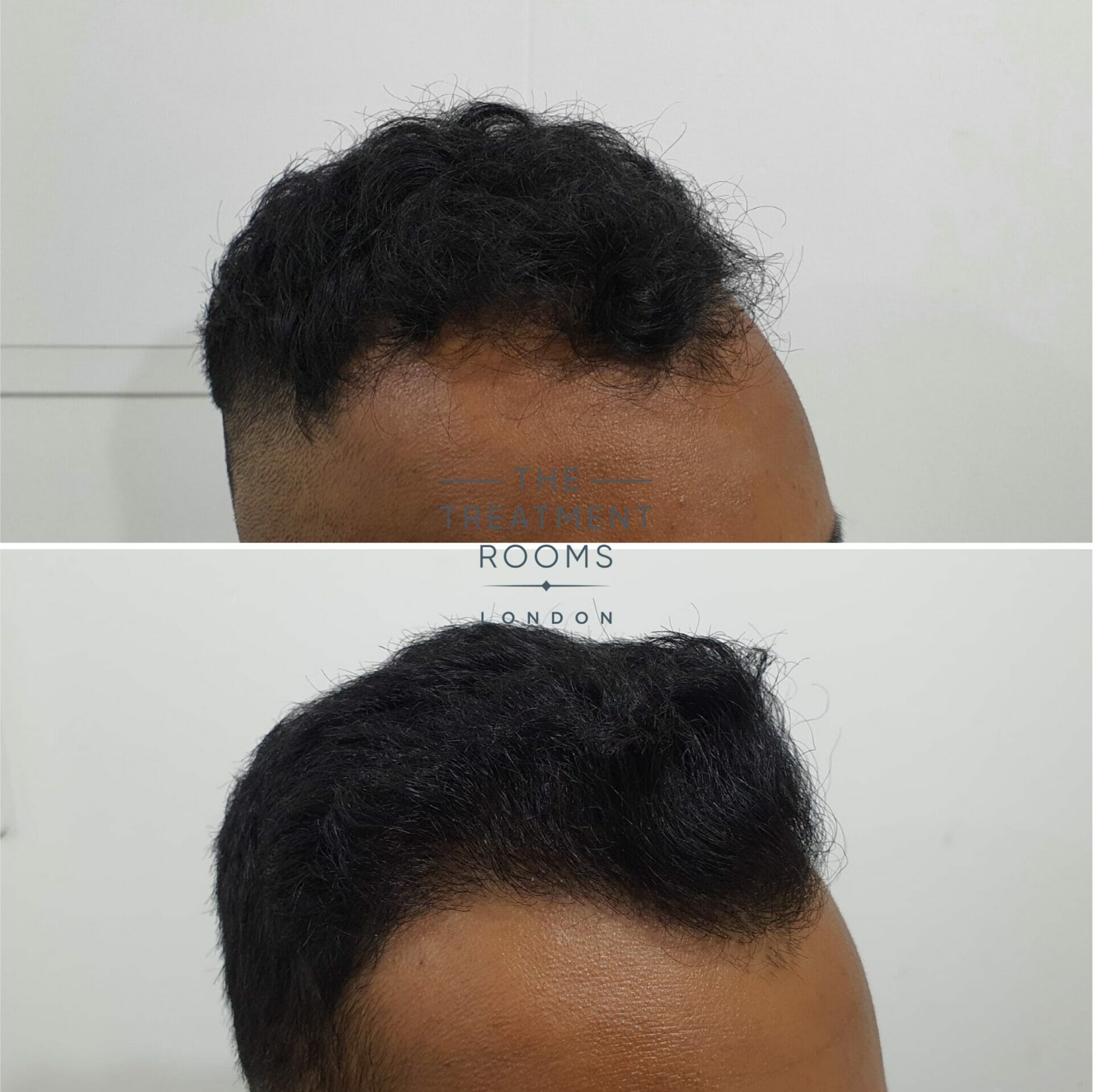 1546 grafts FUE hair transplant london result