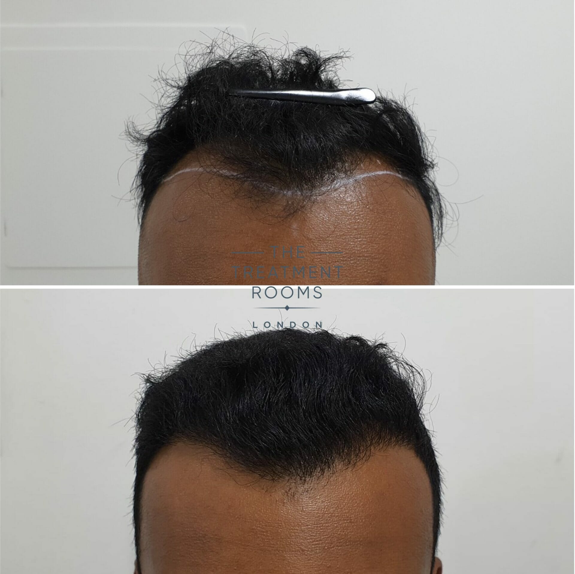 1546 grafts hairline FUE hair transplant result