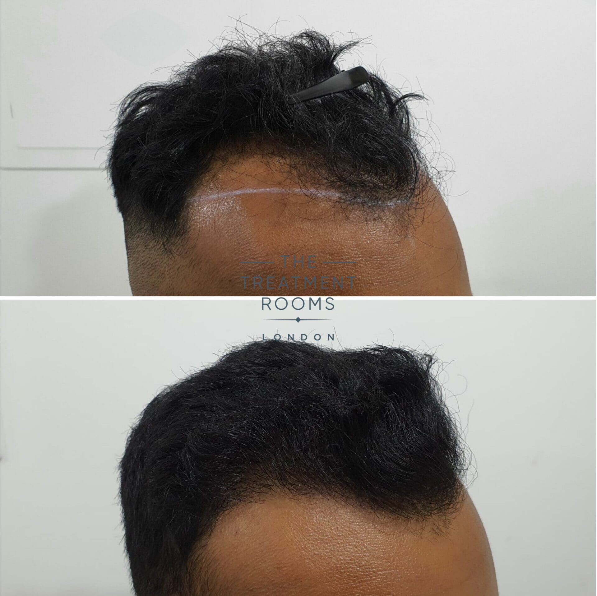 1546 grafts hairline FUE hair transplant