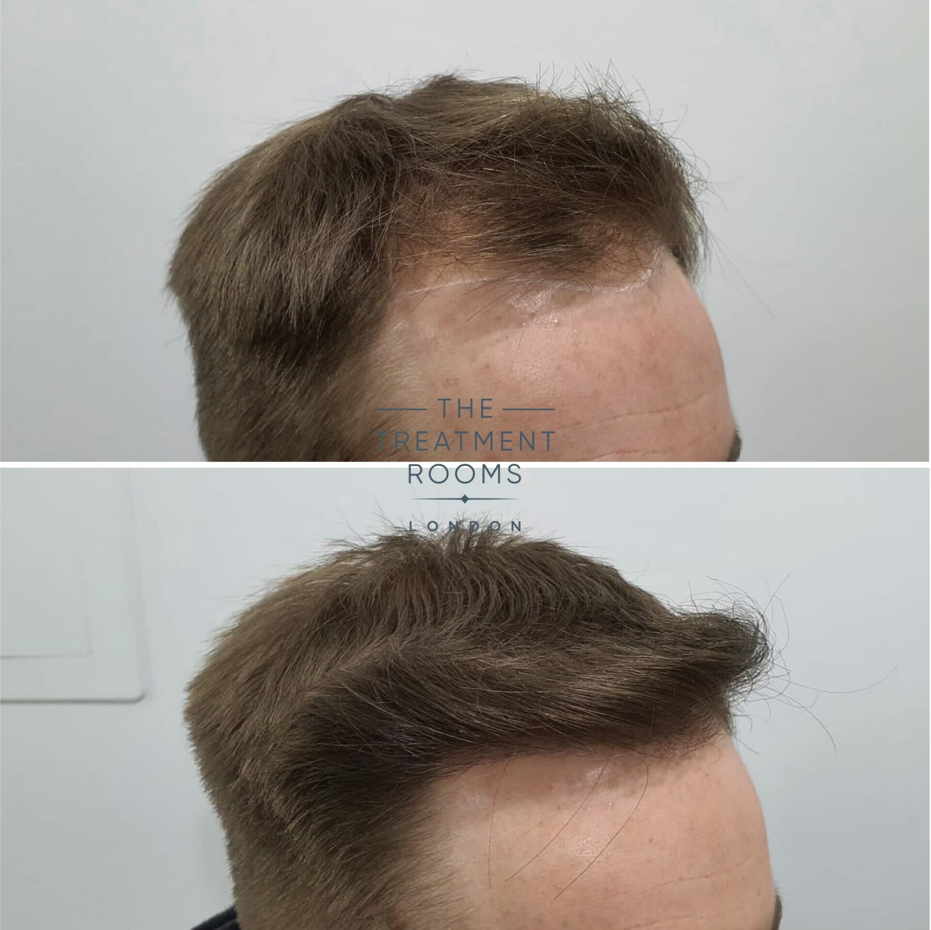 1615 grafts hair transplant london before and after 1615 grafts hair transplant london before and after