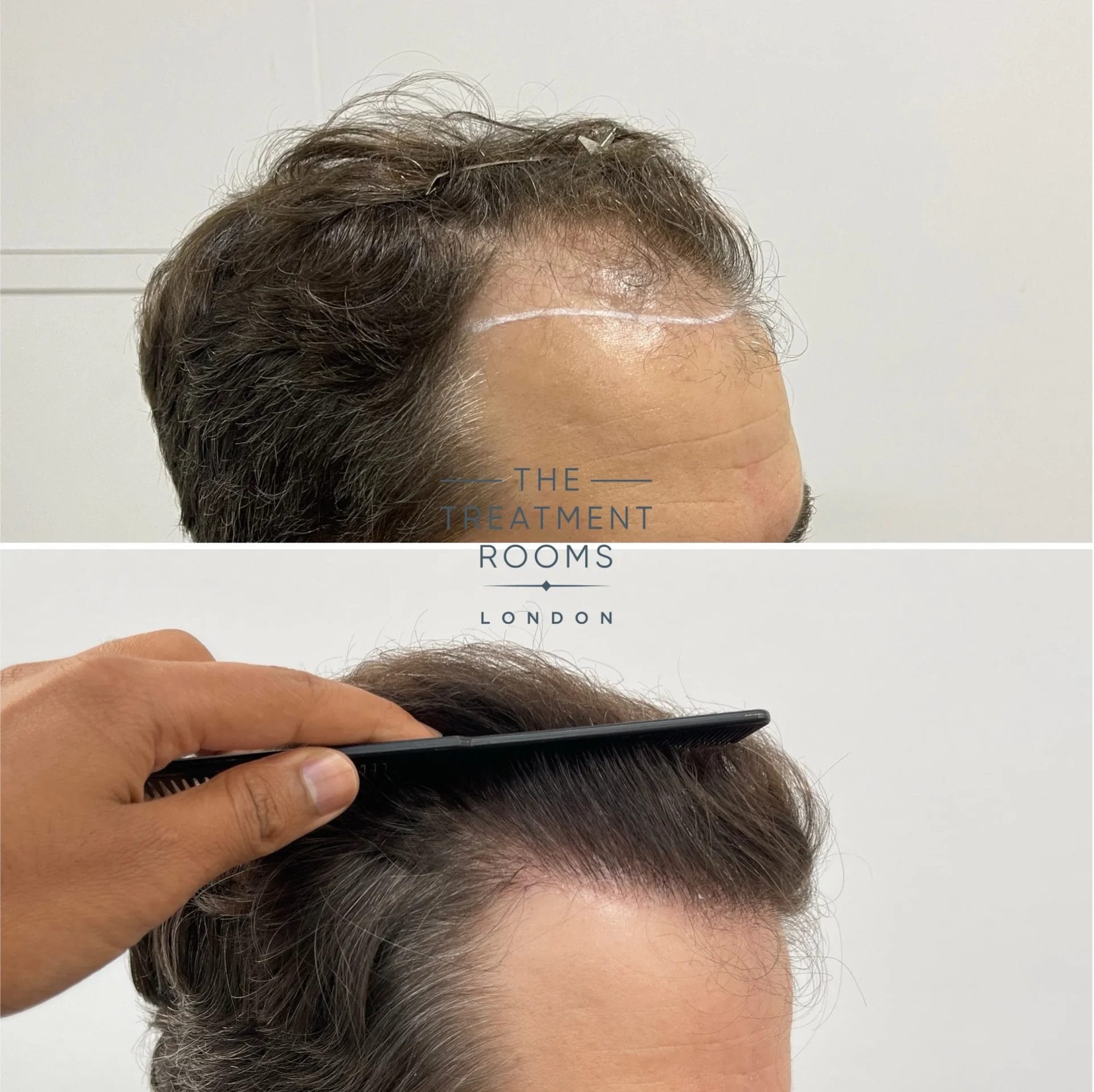 1722 grafts hairline transplant before and after