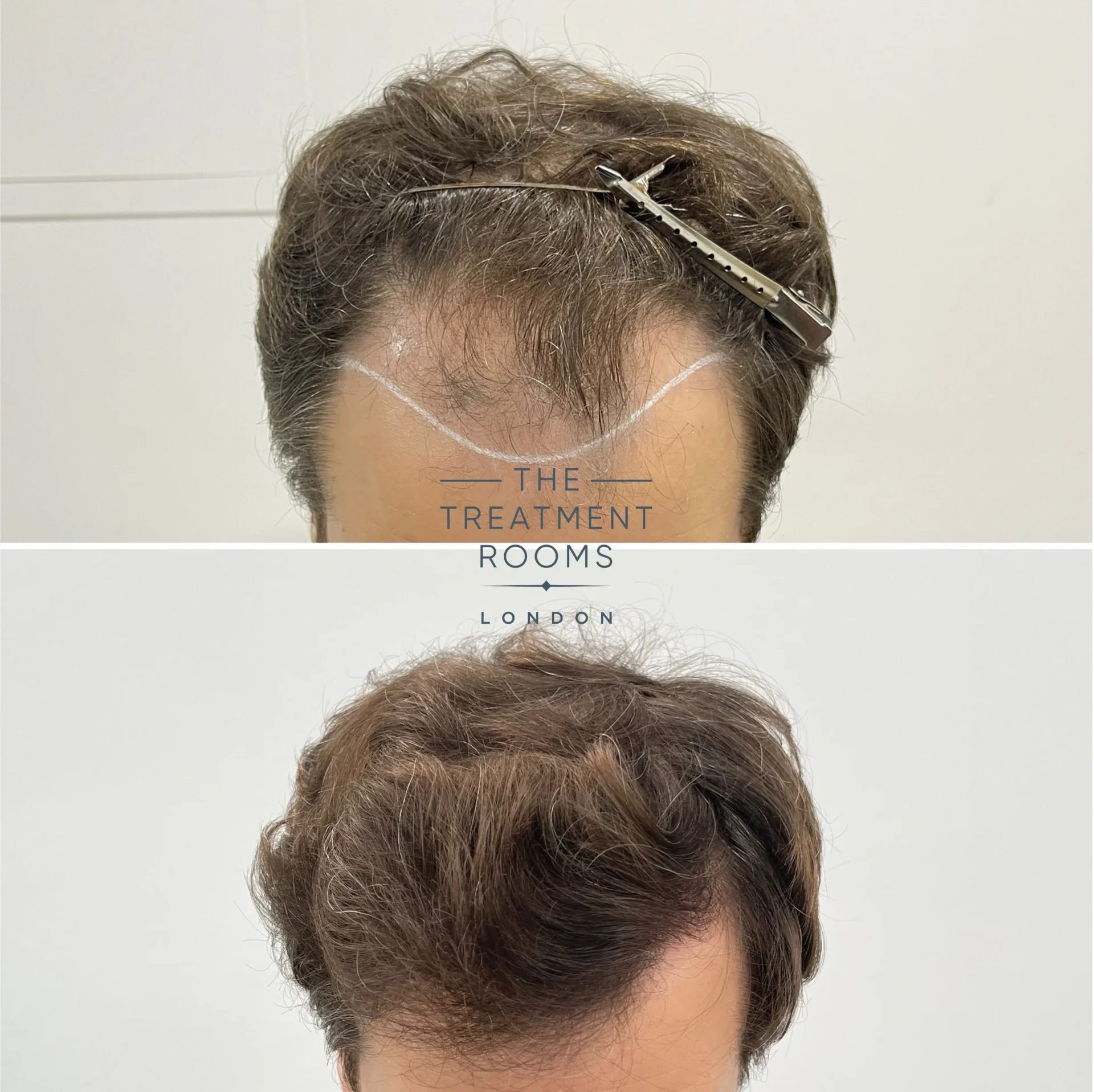 1722 grafts receding hairline transplant before and after