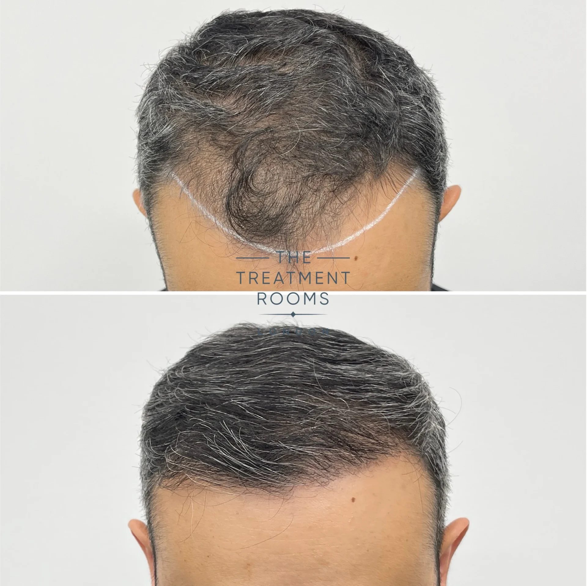 1755 grafts thick wavy fue hair transplant before and after