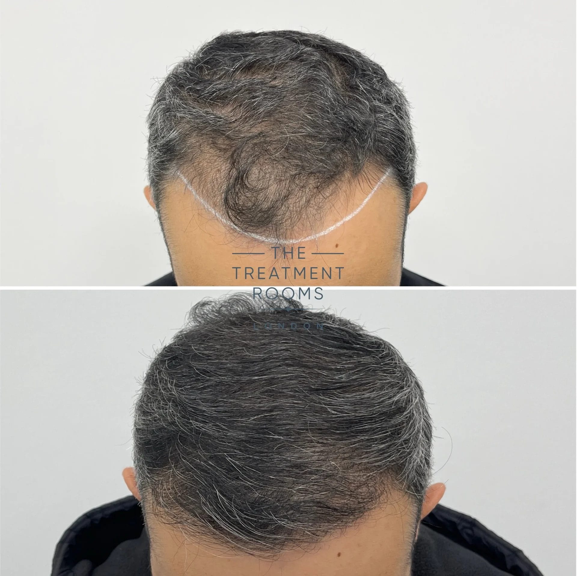1755 grafts thick wavy hair transplant before and after