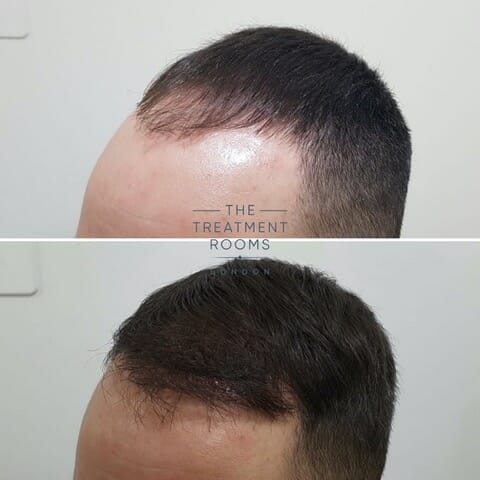 1800 graft FUE hair transplant left