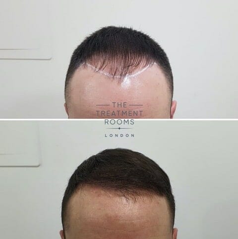 1800 graft FUE hair transplant