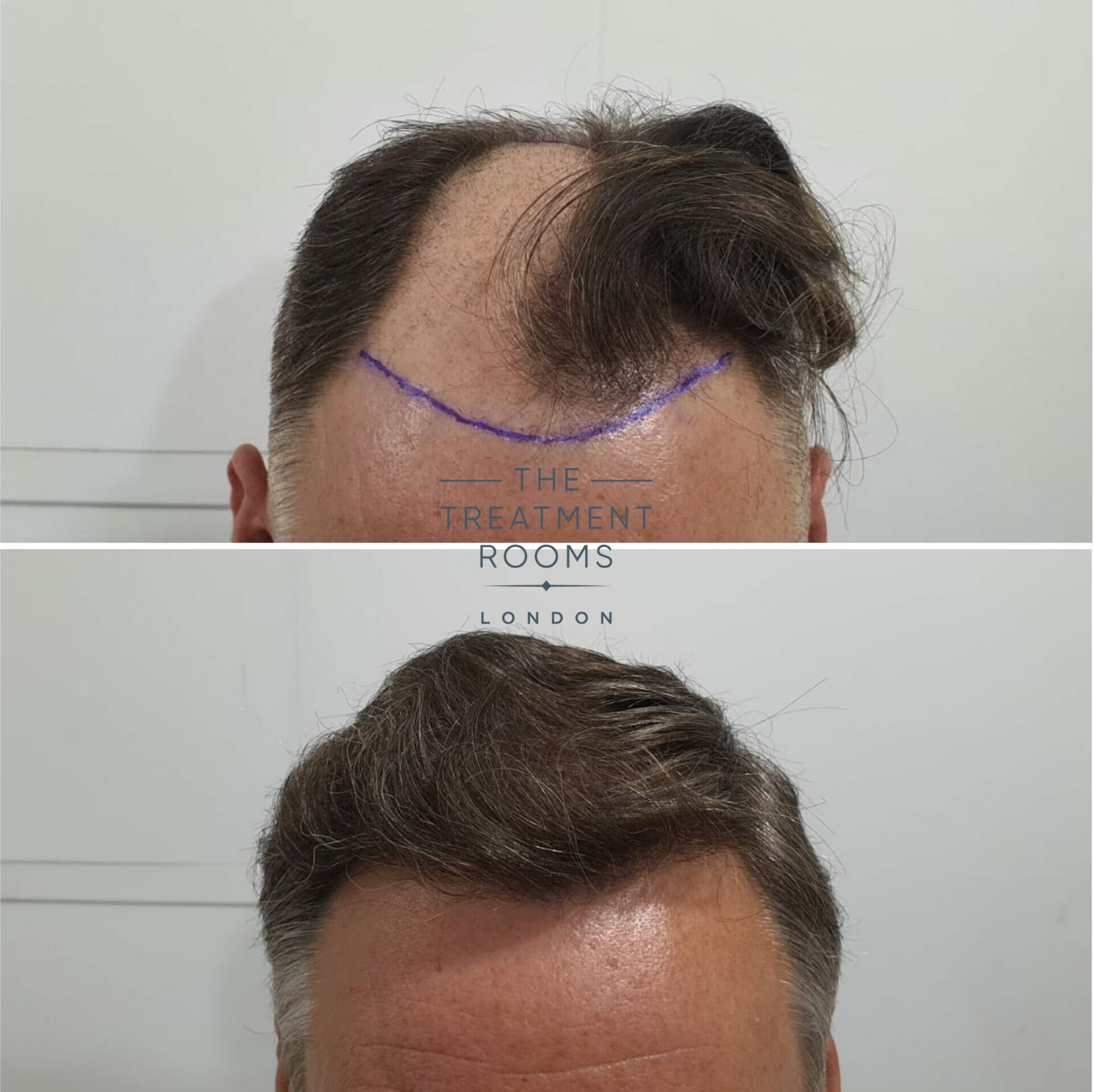 1824 grafts fue hair transplant london 1824 grafts fue hair transplant london