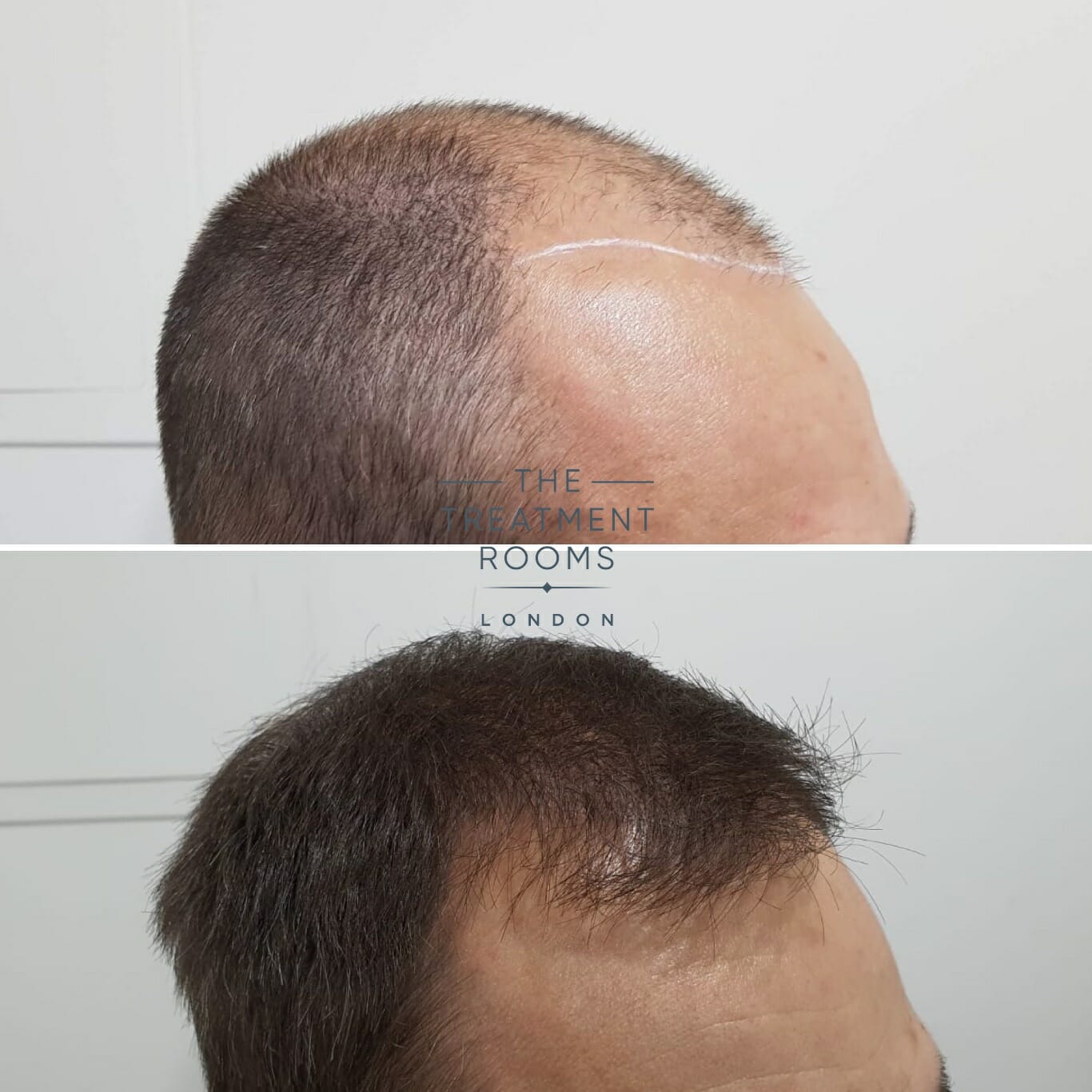 2000 graft hair transplant result 2000 graft hair transplant result