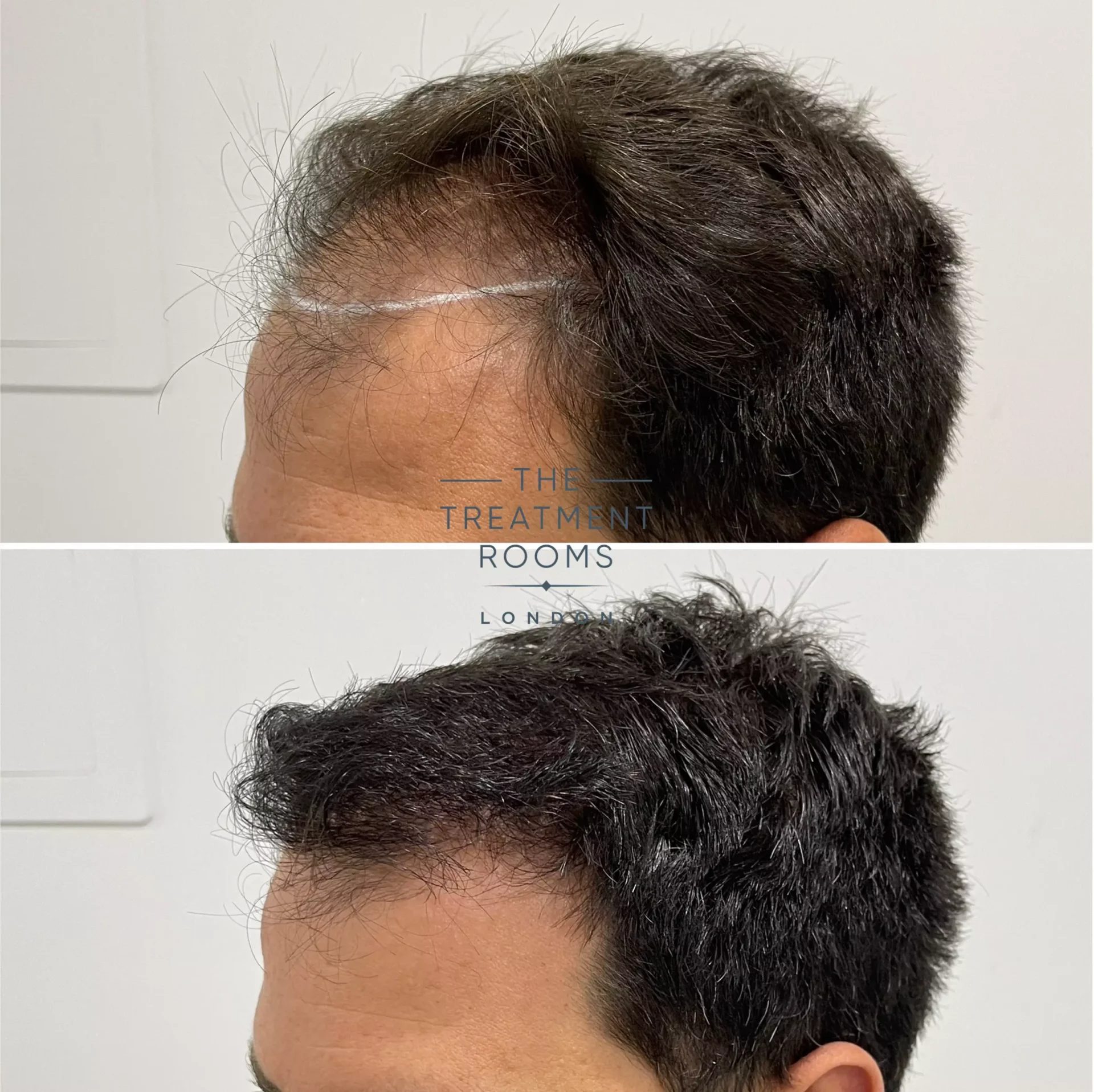 2170 grafts hair transplant before and after