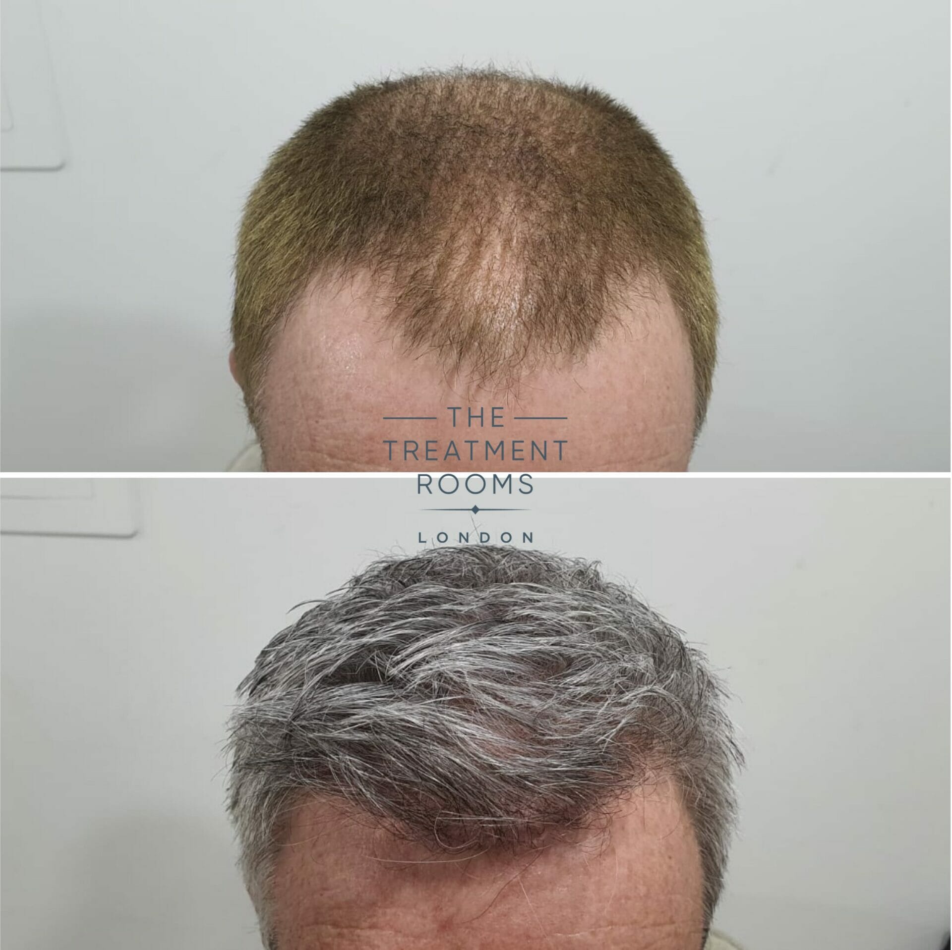 2322 graft fue hairline transplant result