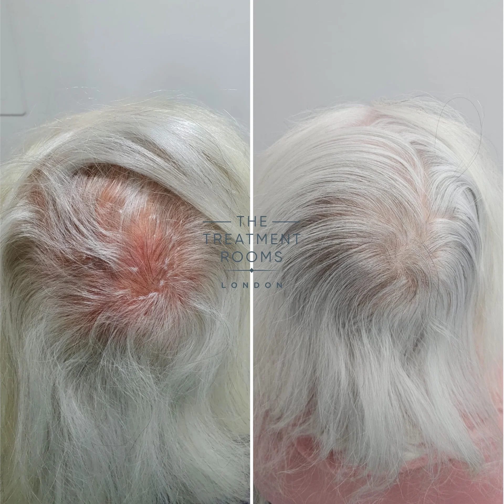 2390 grafts transgender hair transplant crown