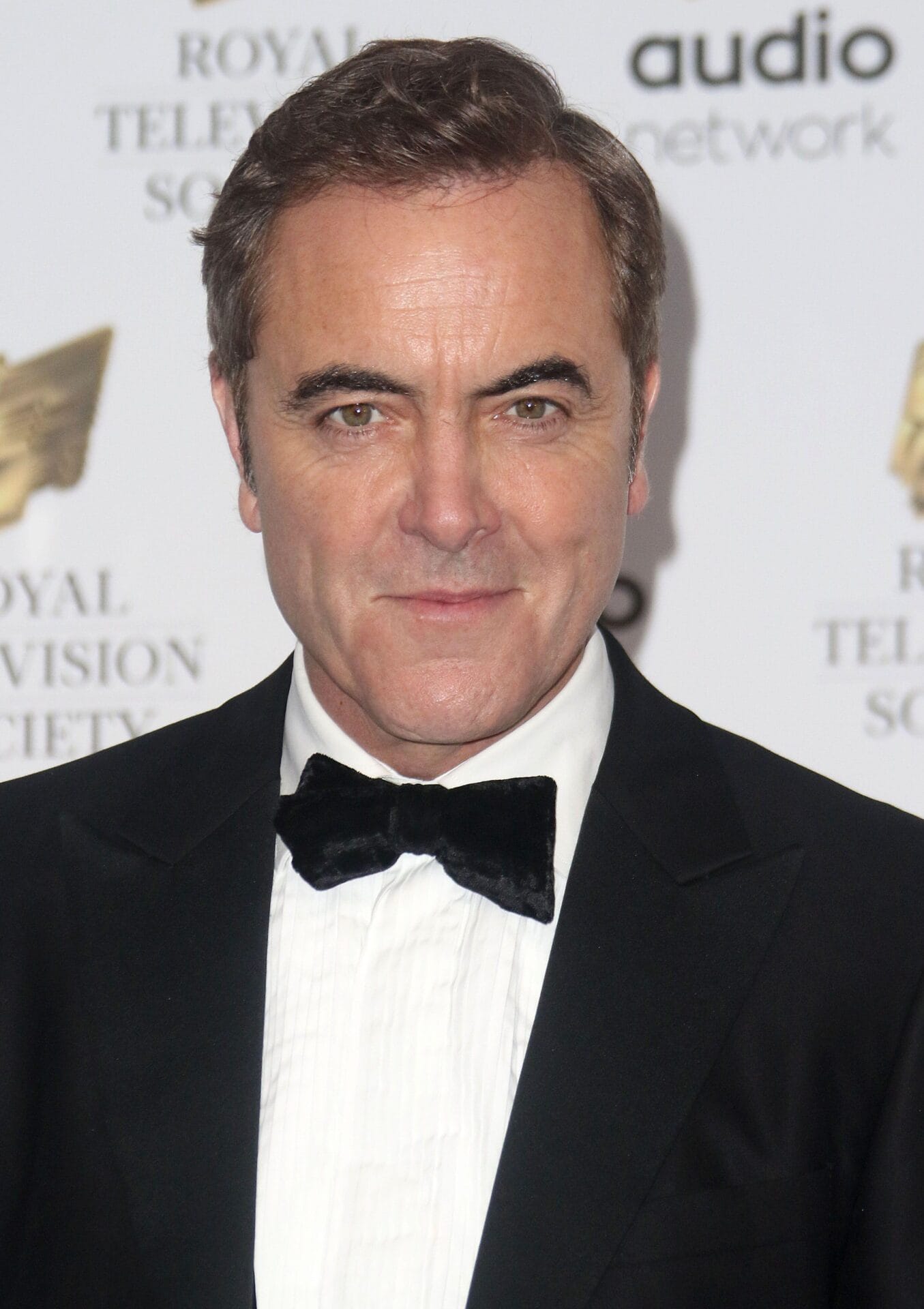James Nesbitt Hair Transplant