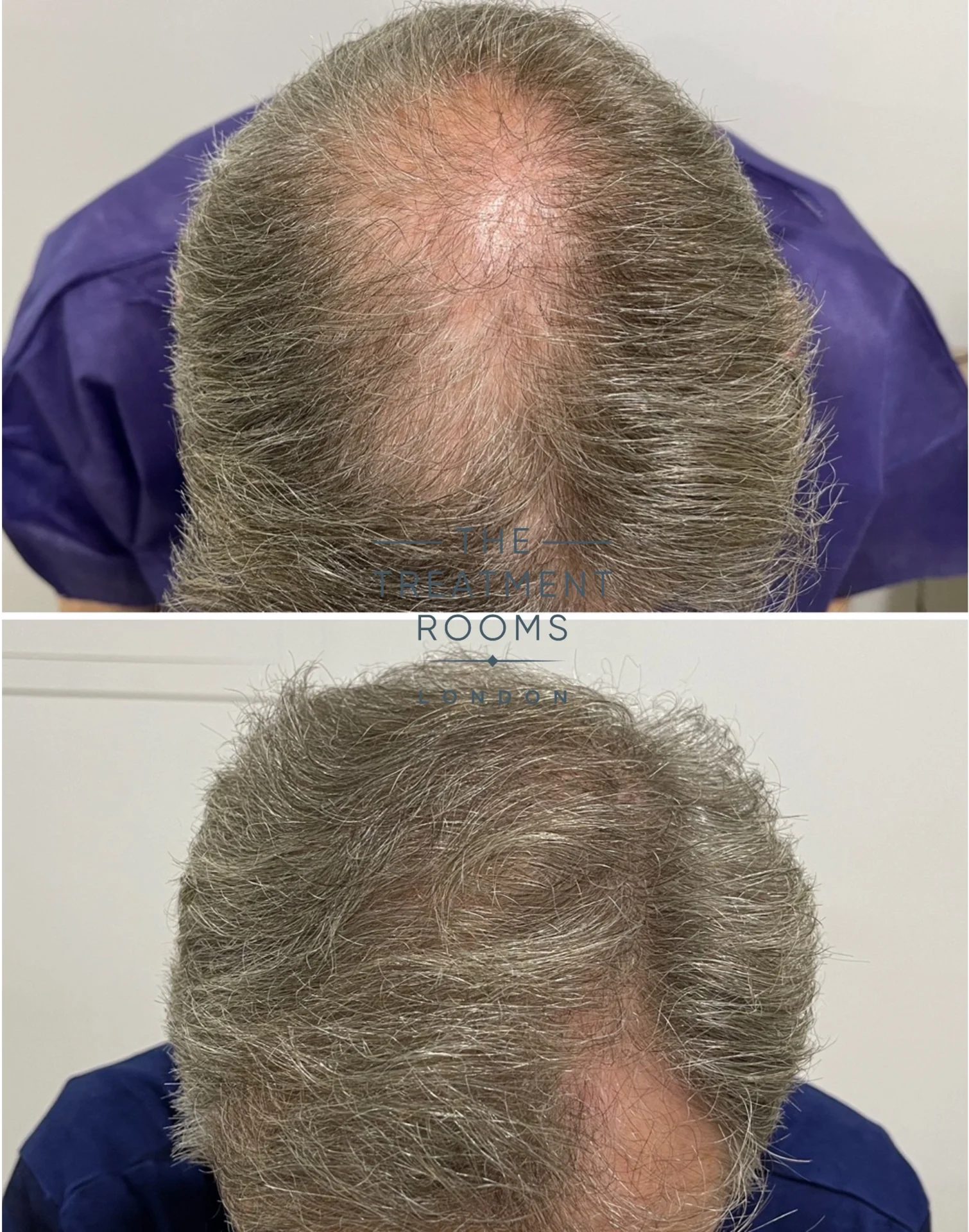 681 grafts crown hair transplant