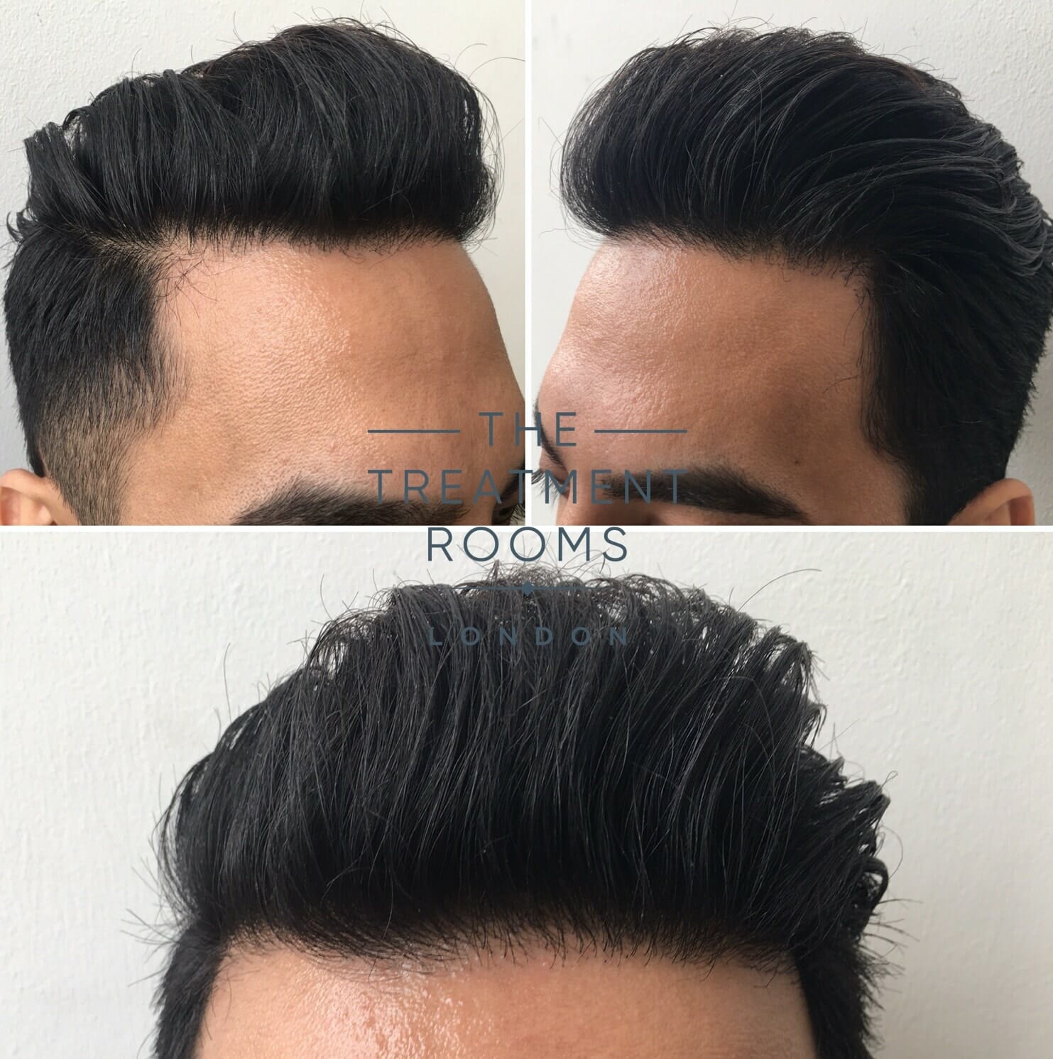 After FUE Hair transplant London hairline After FUE Hair transplant London hairline