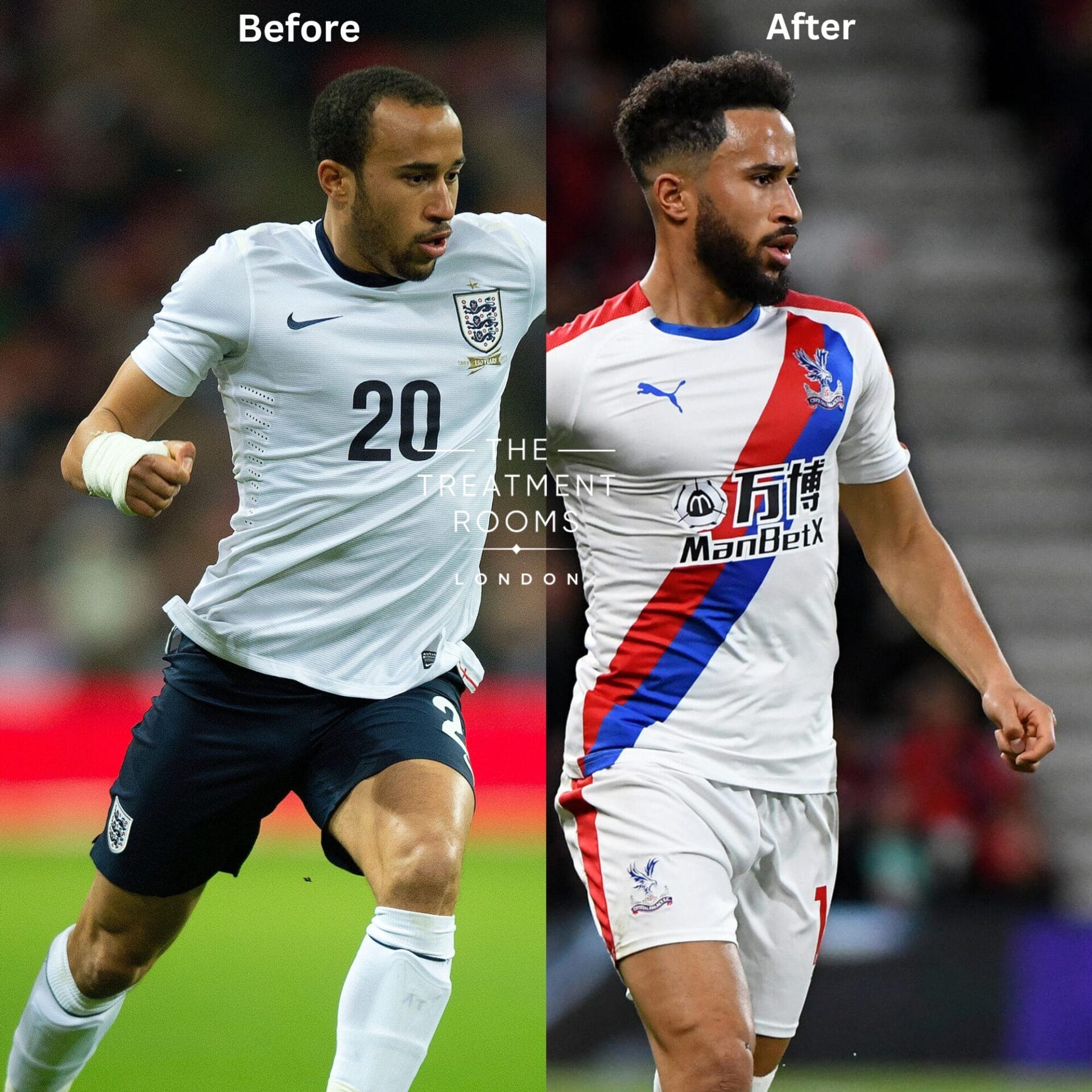 two images showing before and after of Andros Townsend hair transplant.