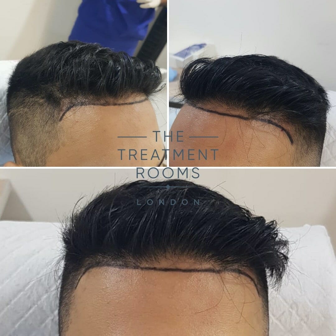 Before FUE hair transplant Before FUE hair transplant