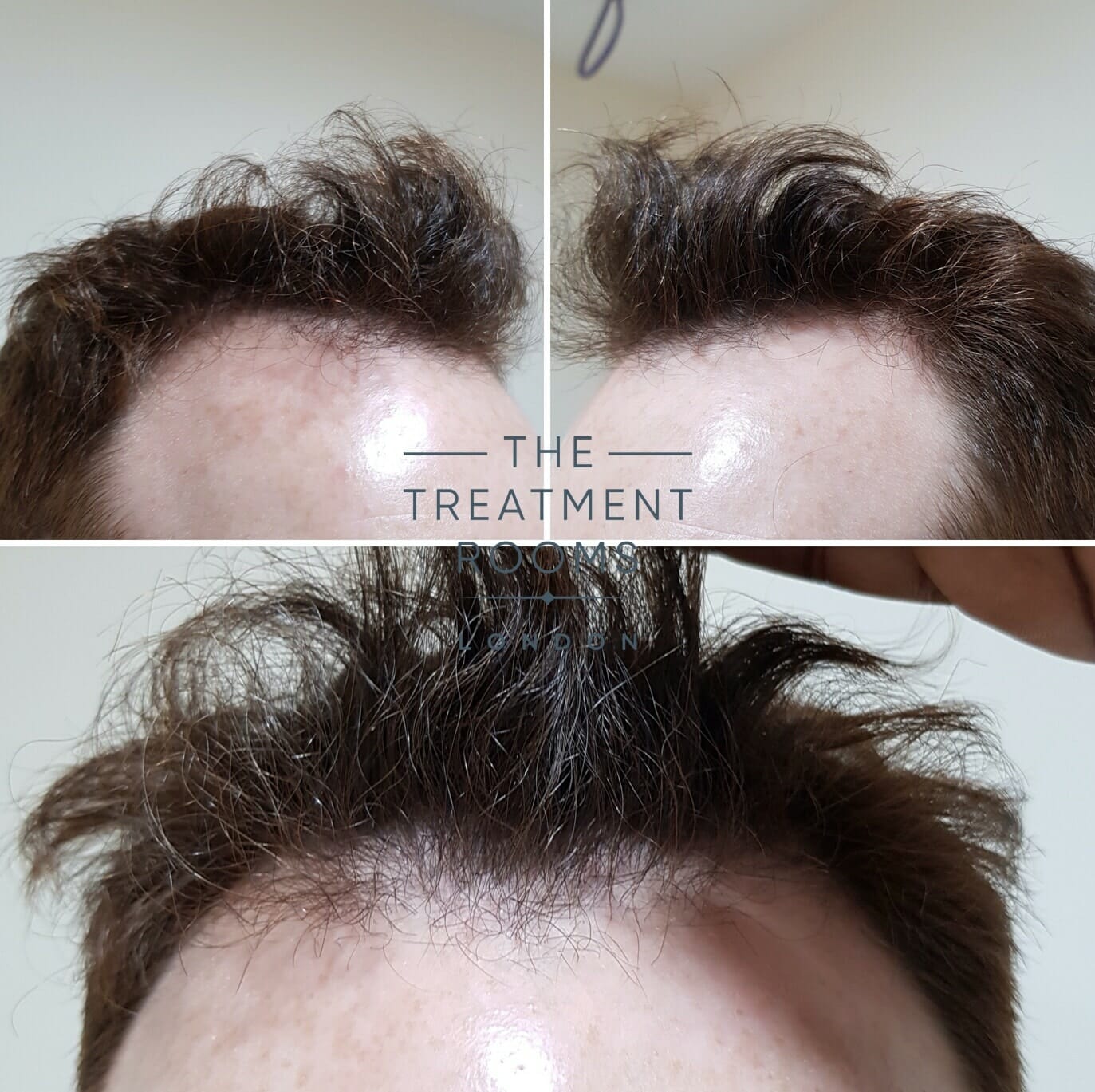 Before FUE hair transplant front and temporal regions Before FUE hair transplant front and temporal regions
