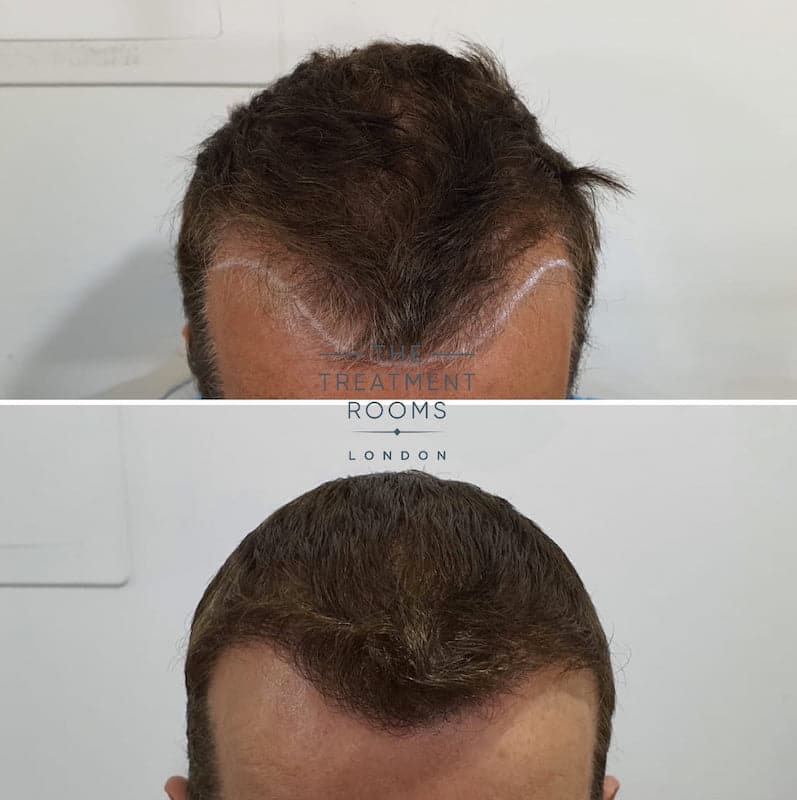 Before and after FUE hair transplant hairline 1452 grafts Before and after FUE hair transplant hairline 1452 grafts