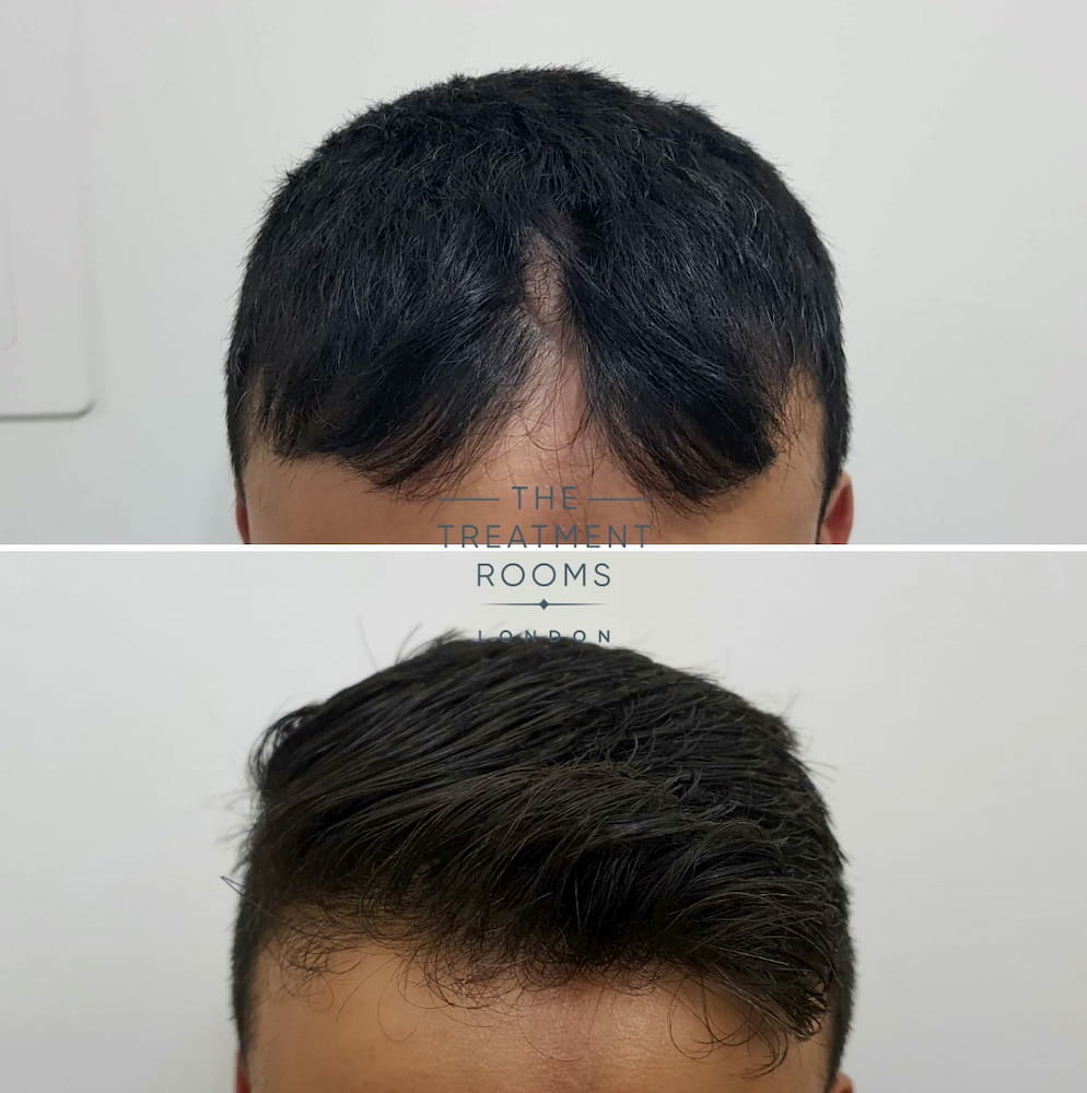 Before-and-after-hair-transplant-17 hair transplant linear scleroderma scar