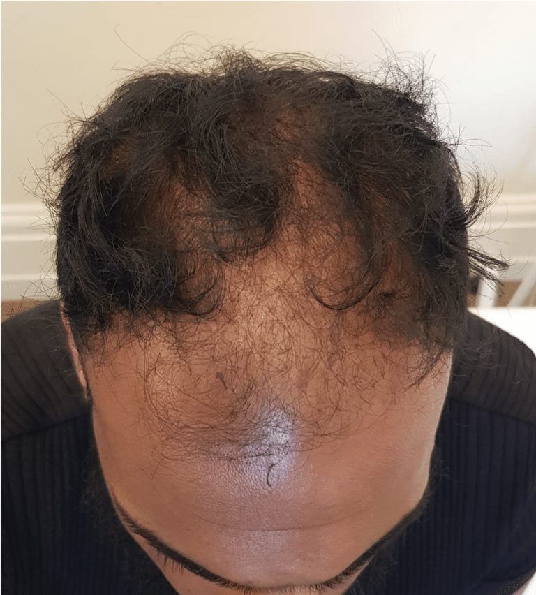 Before hair transplant