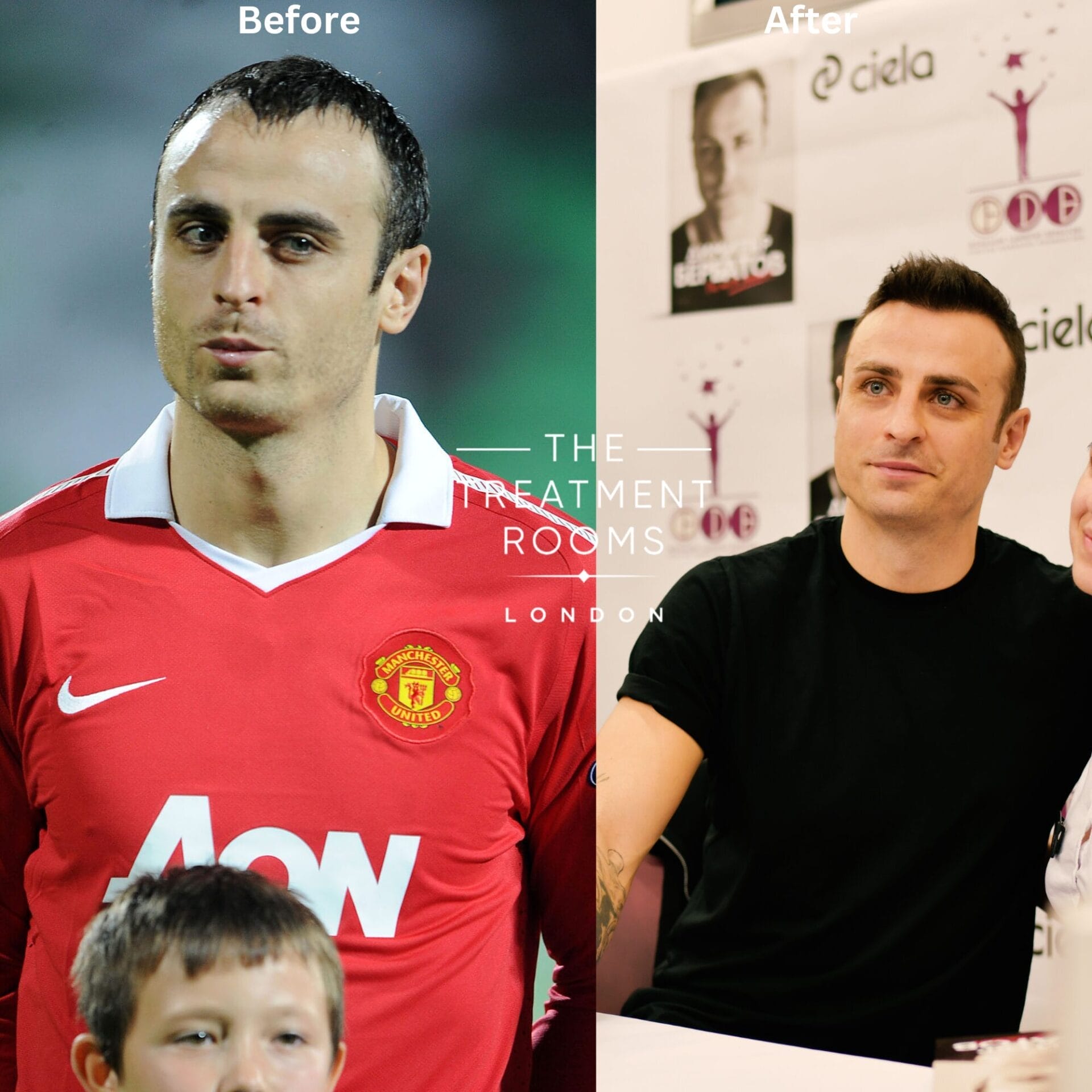 dimitar berbatov hair transplant before and after