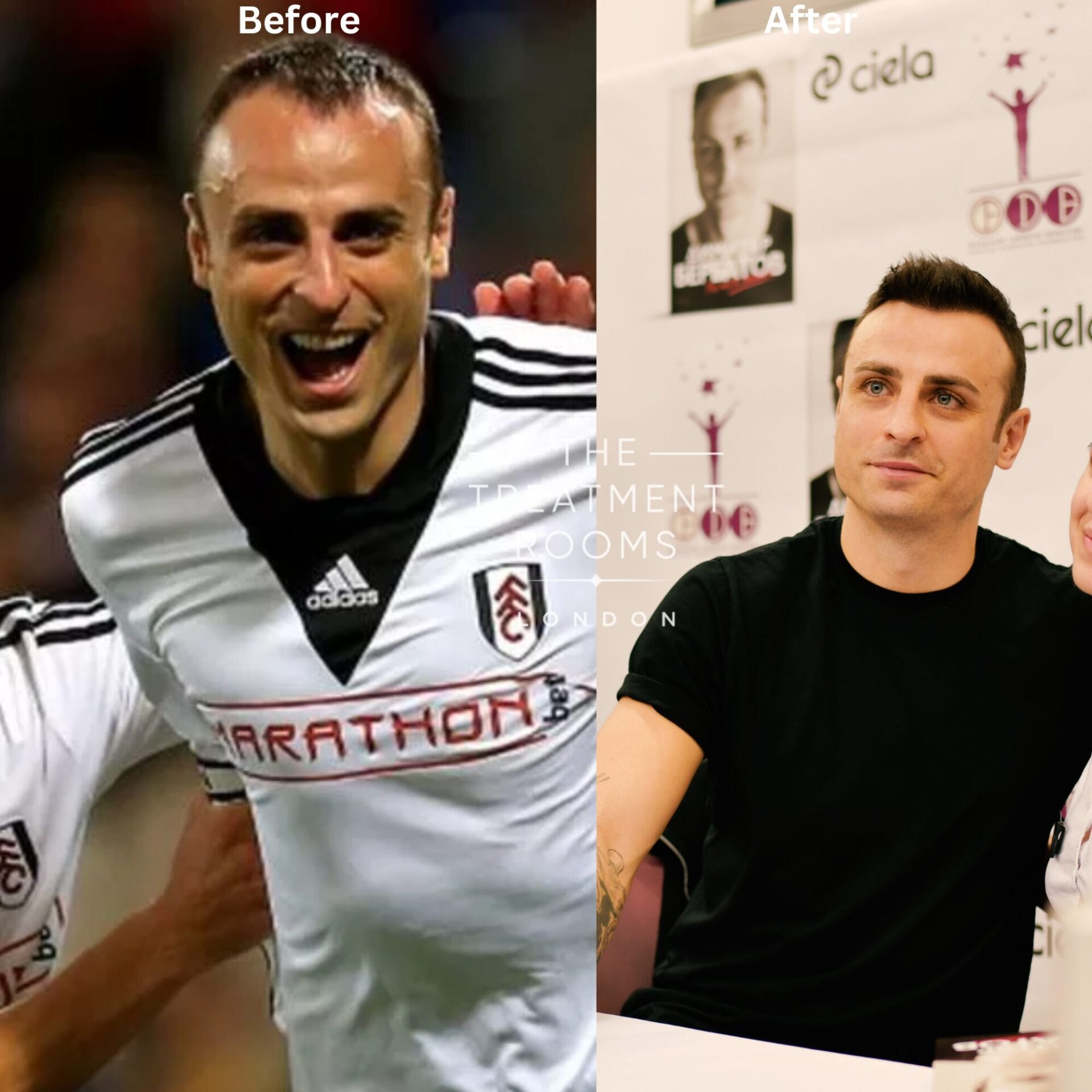 before and after picture of Dimitar Berbatov hair transplant